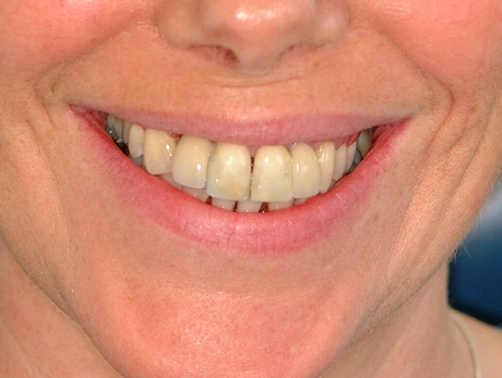 Cosmetic Dentistry - clinical photograph 6