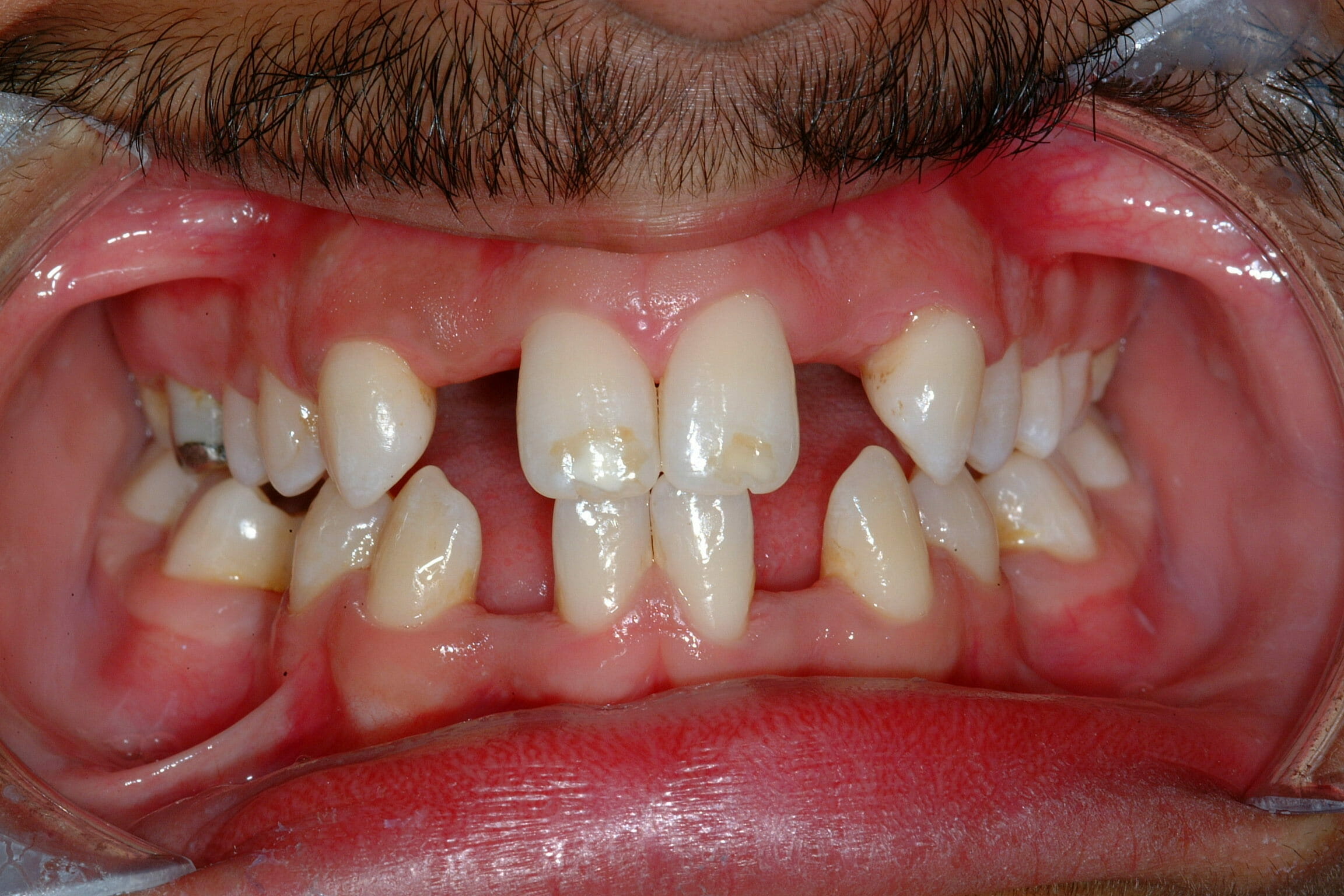 Cosmetic Dentistry - clinical photograph 3