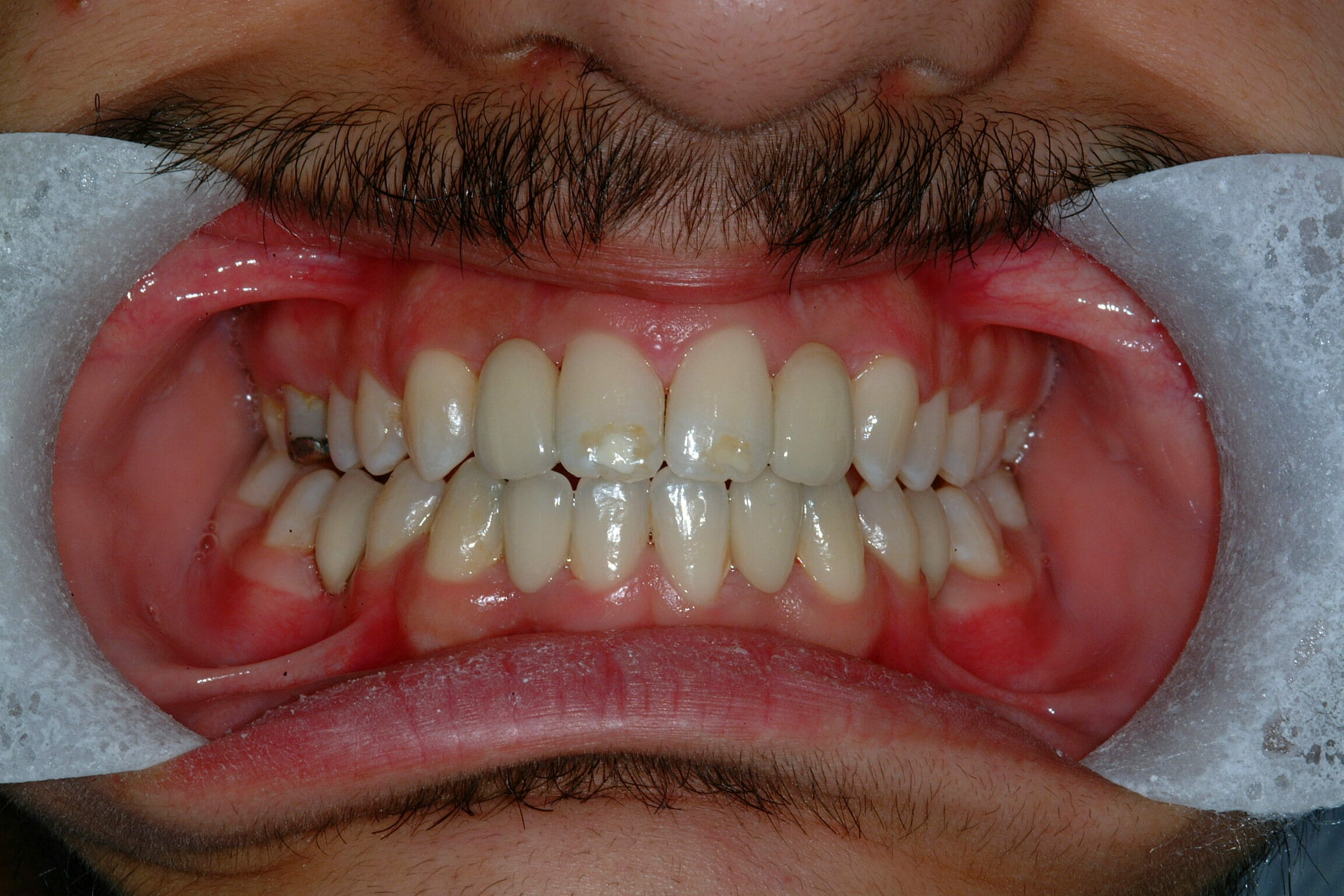 Cosmetic Dentistry - clinical photograph 4