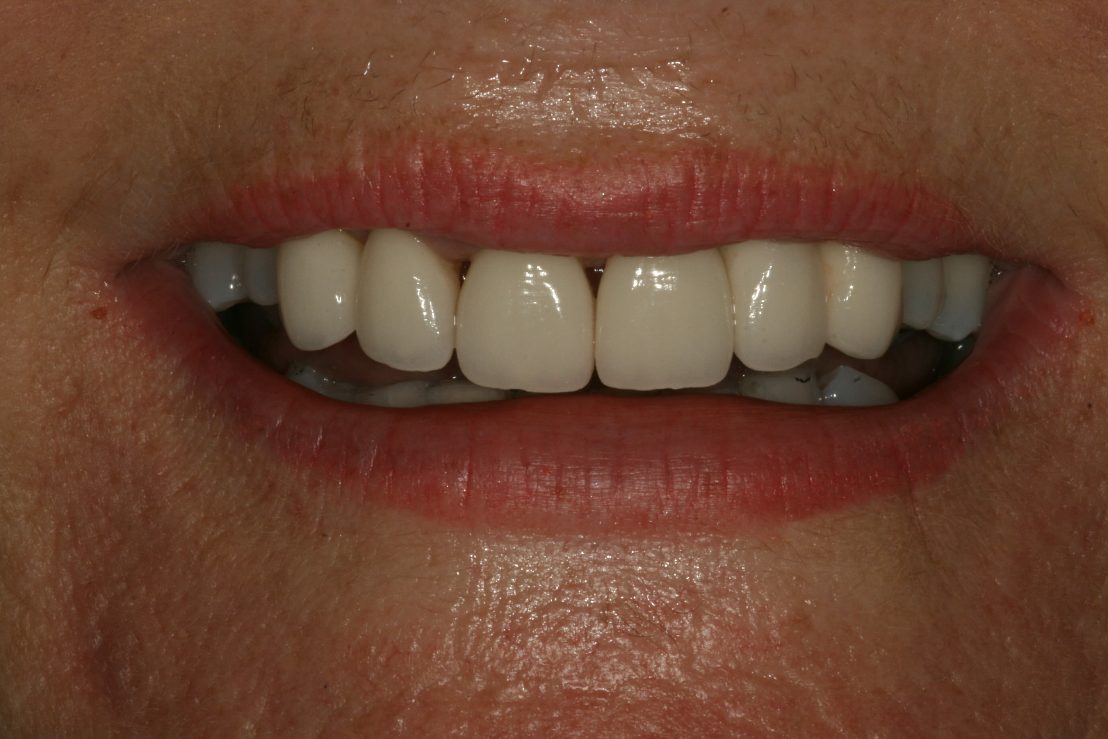 Cosmetic Dentistry - clinical photograph 8