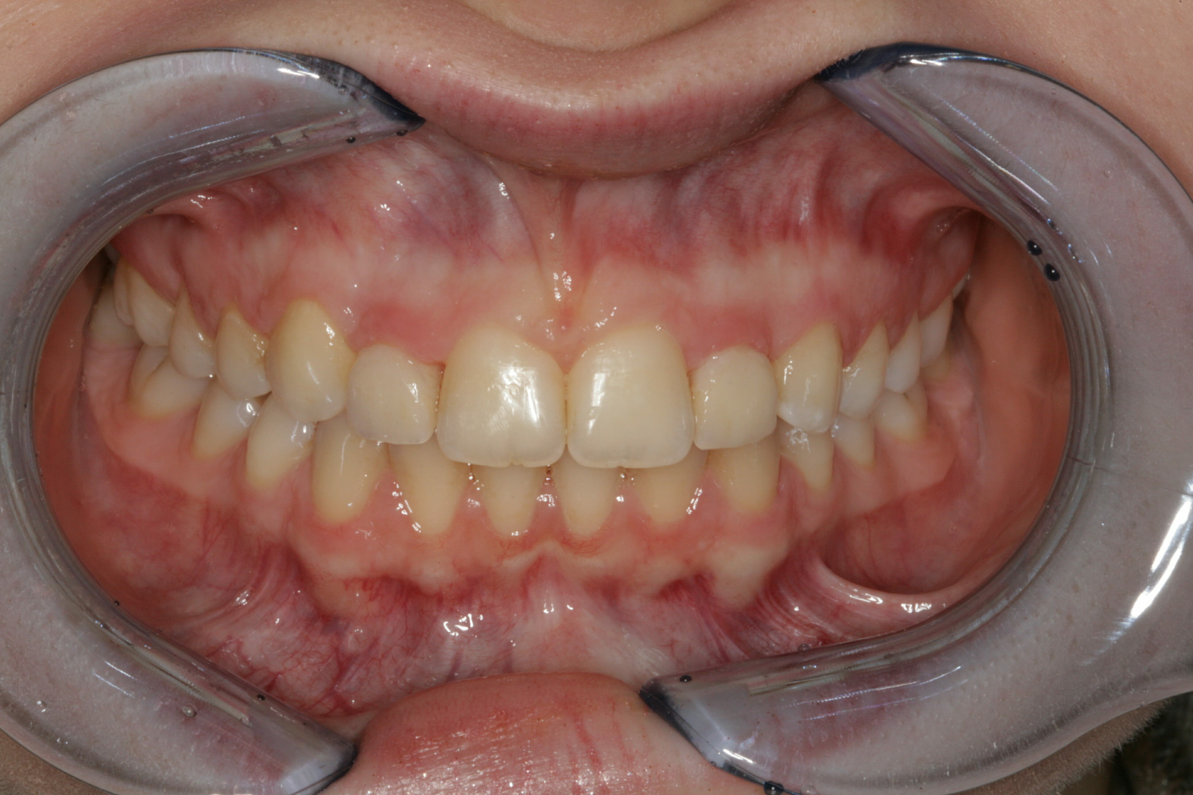 Cosmetic Dentistry - clinical photograph 1