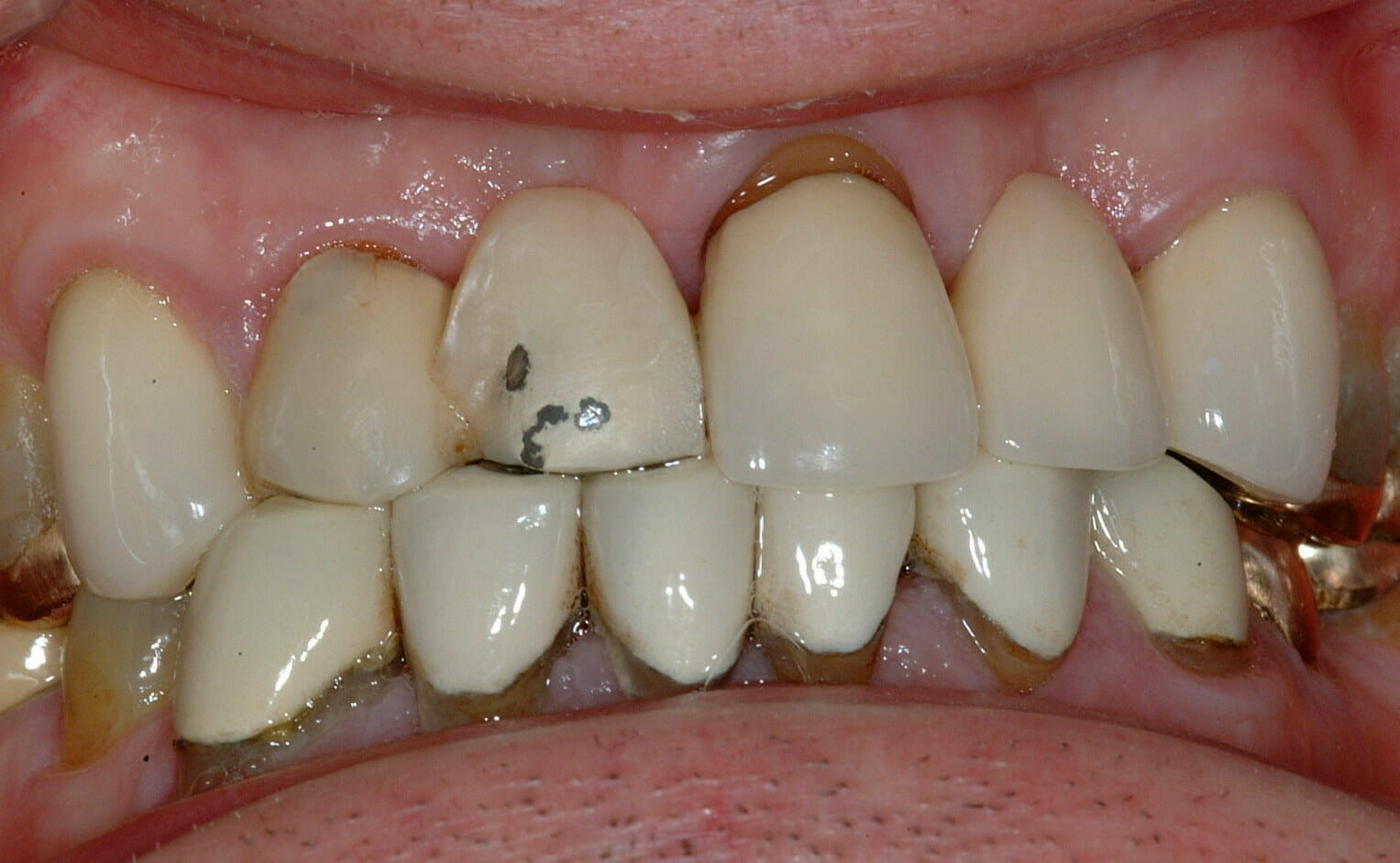 Old crowns with fractured porcelain.