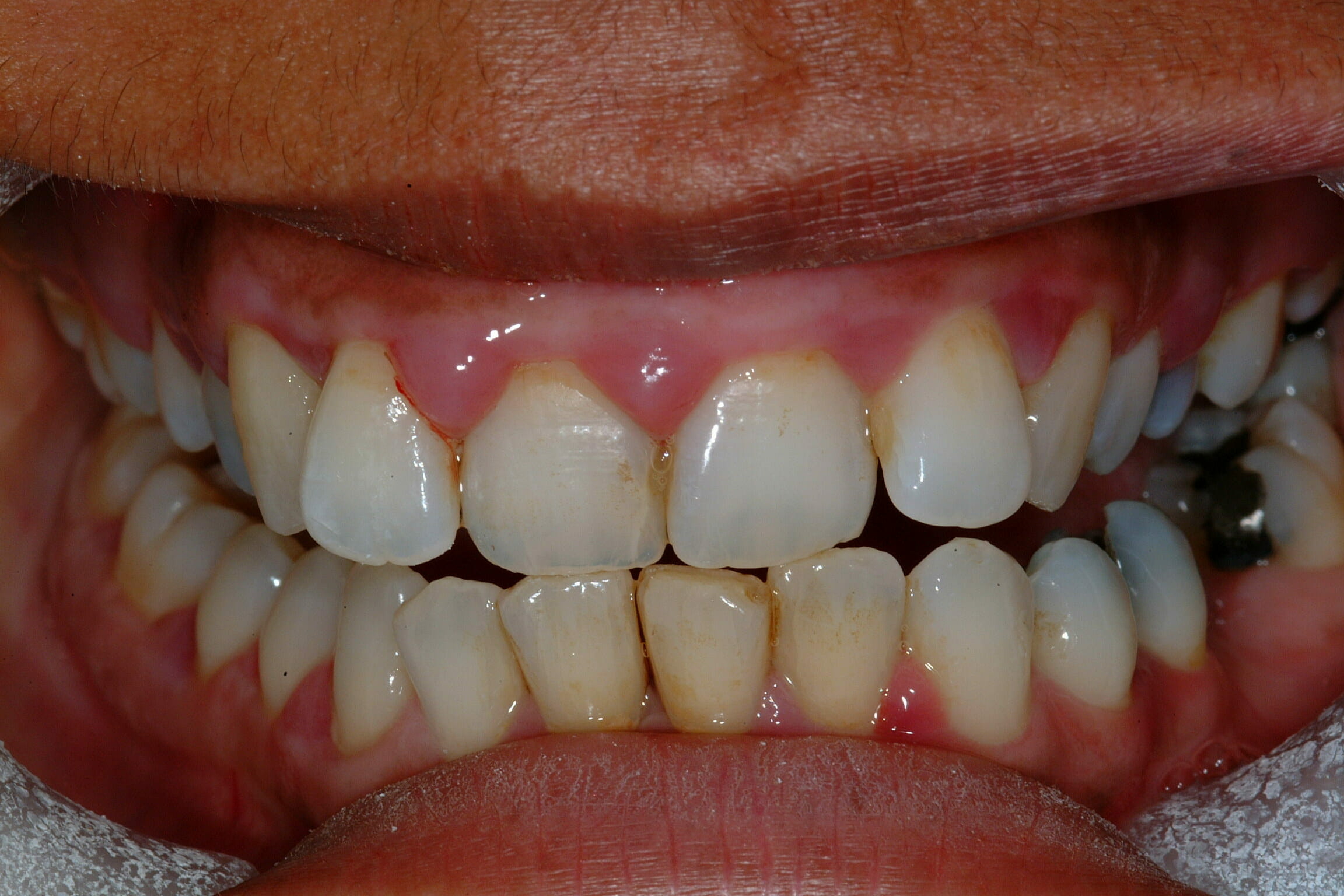Gum Disease Treatment - clinical photograph 1