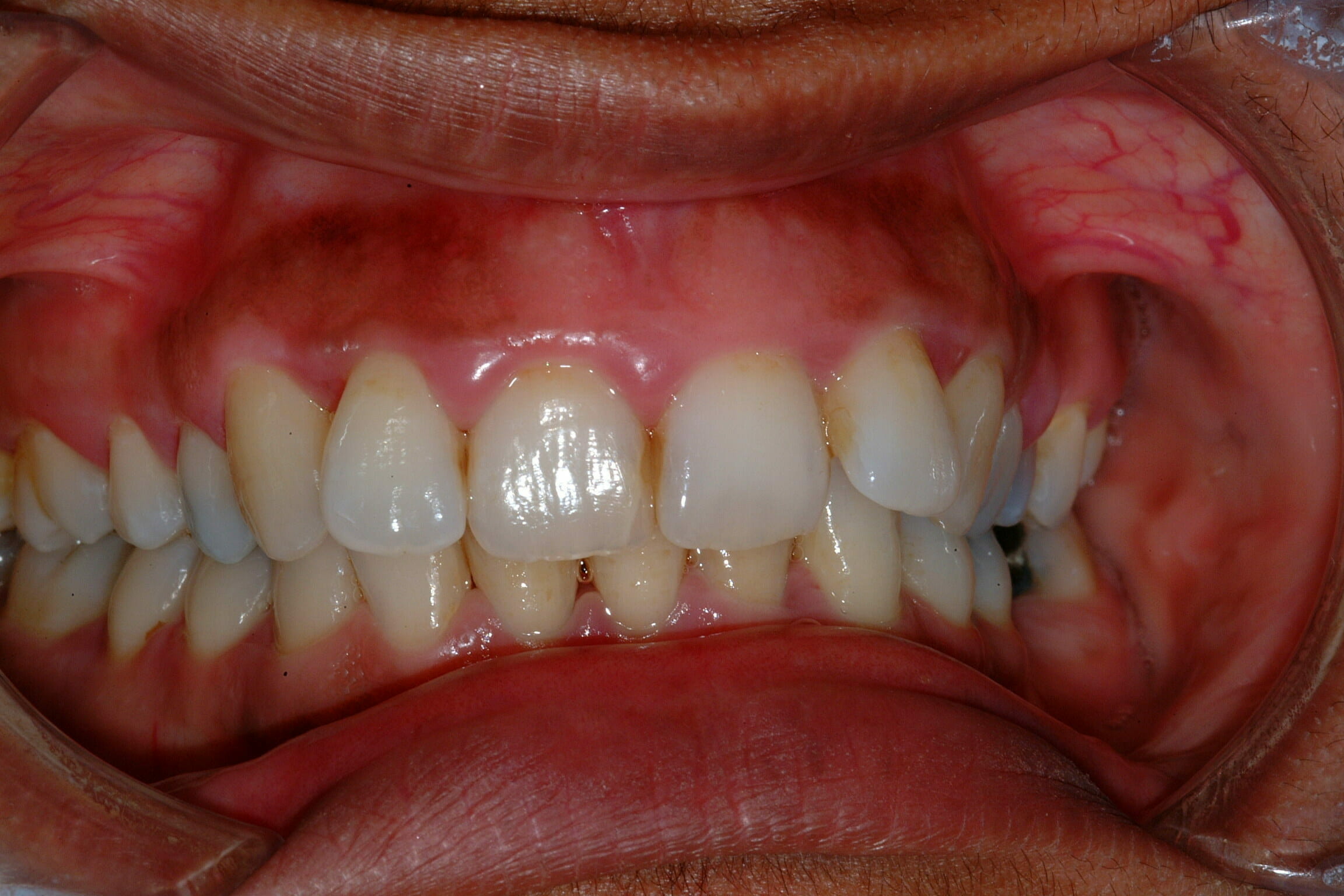 Gum Disease Treatment - clinical photograph 2