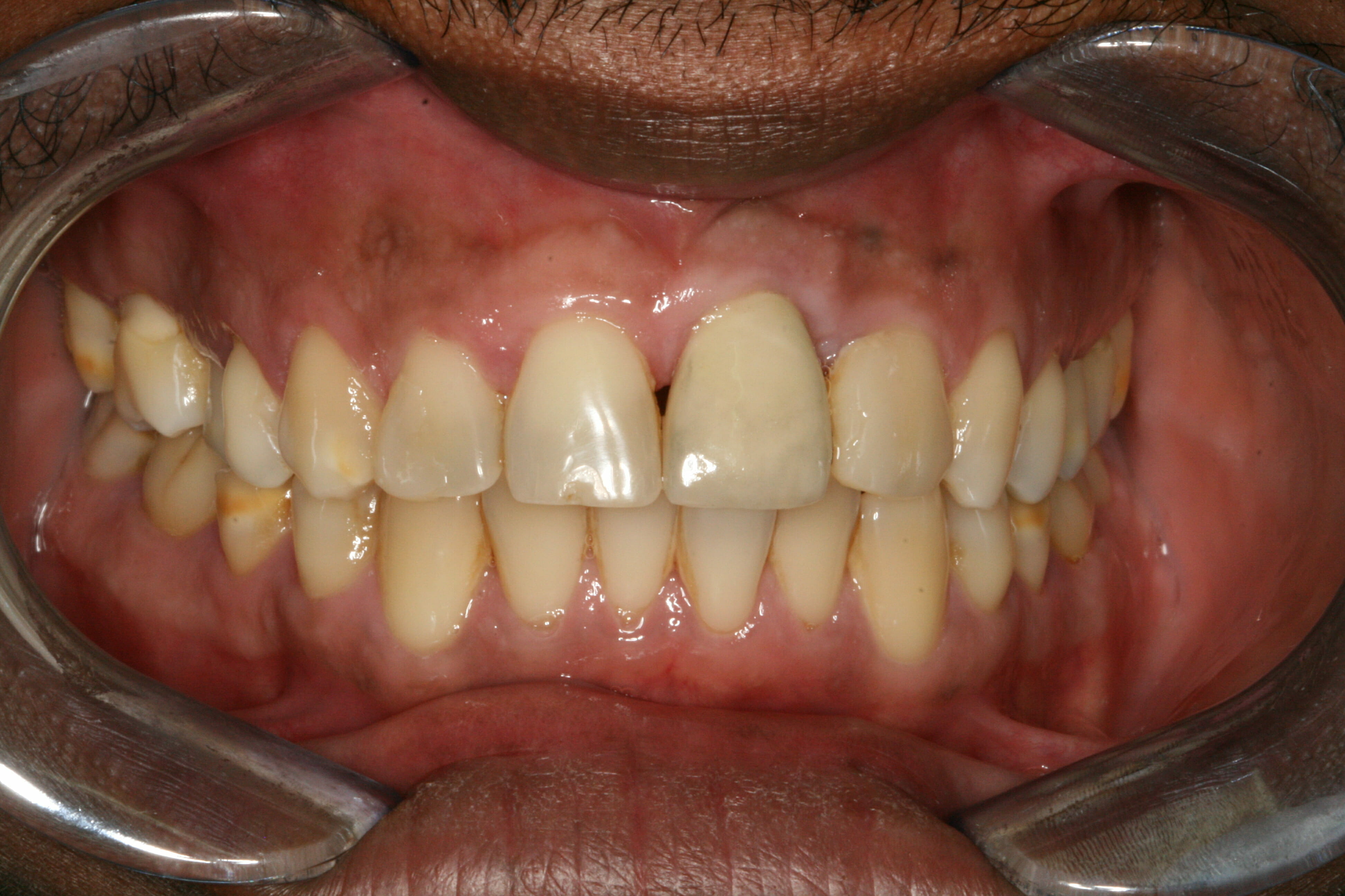 Dental Implants - clinical photograph 2