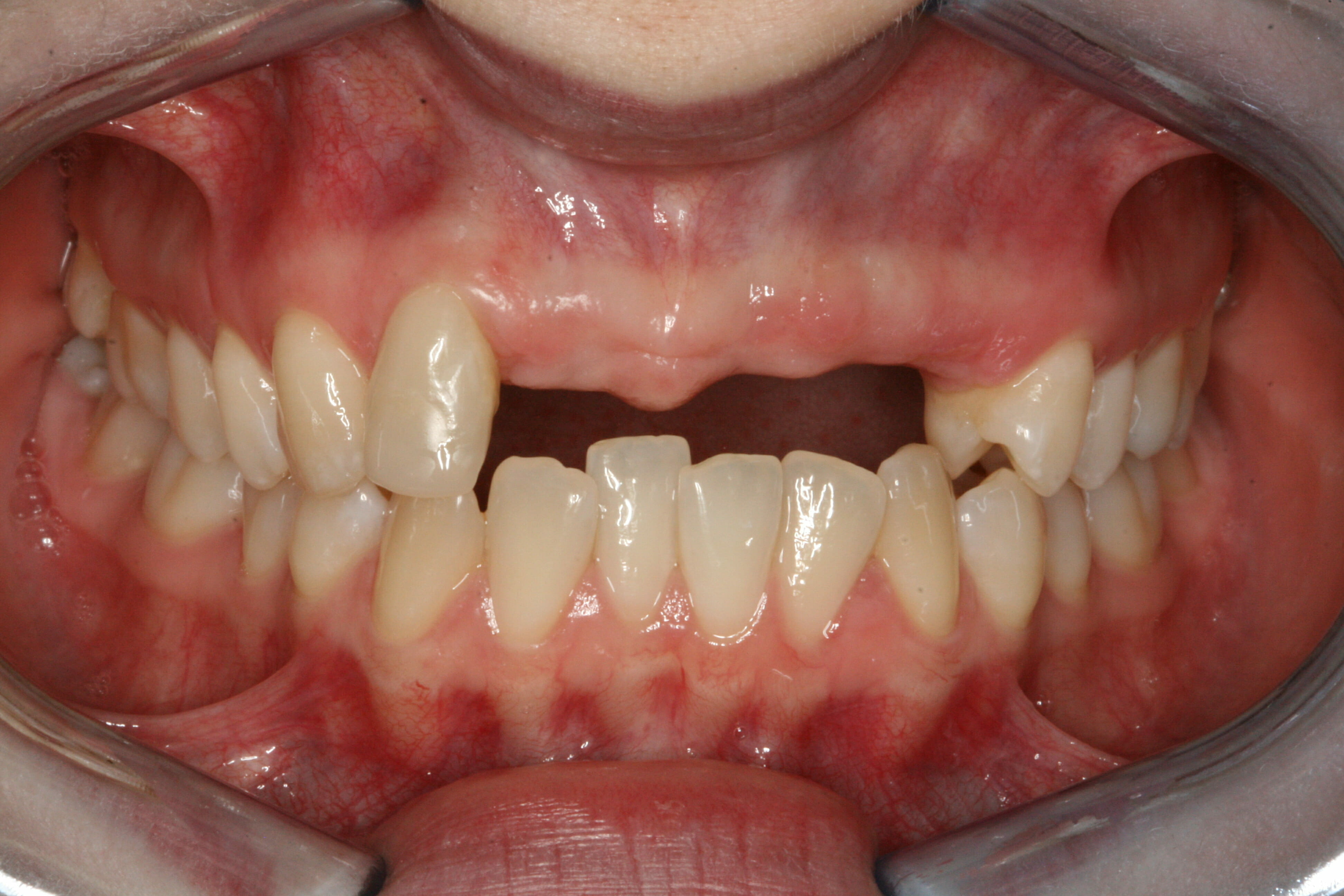 Dental Implants - clinical photograph 5