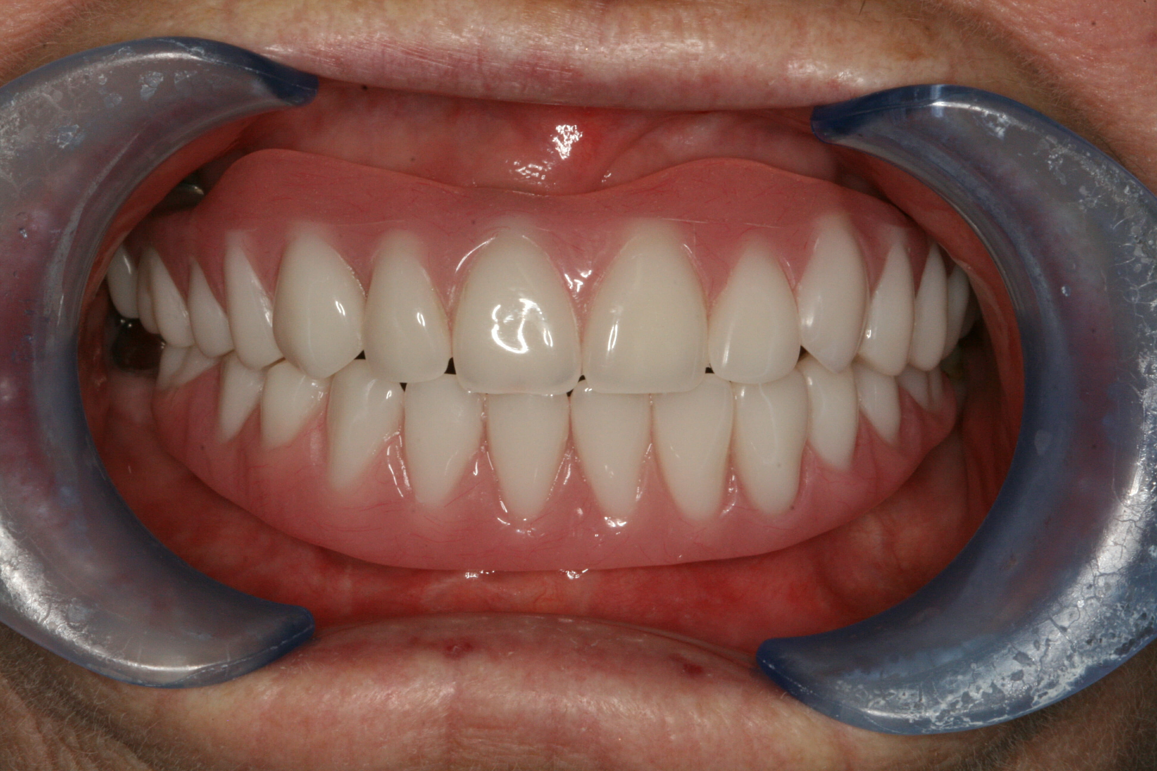 Dental Implants - clinical photograph 4