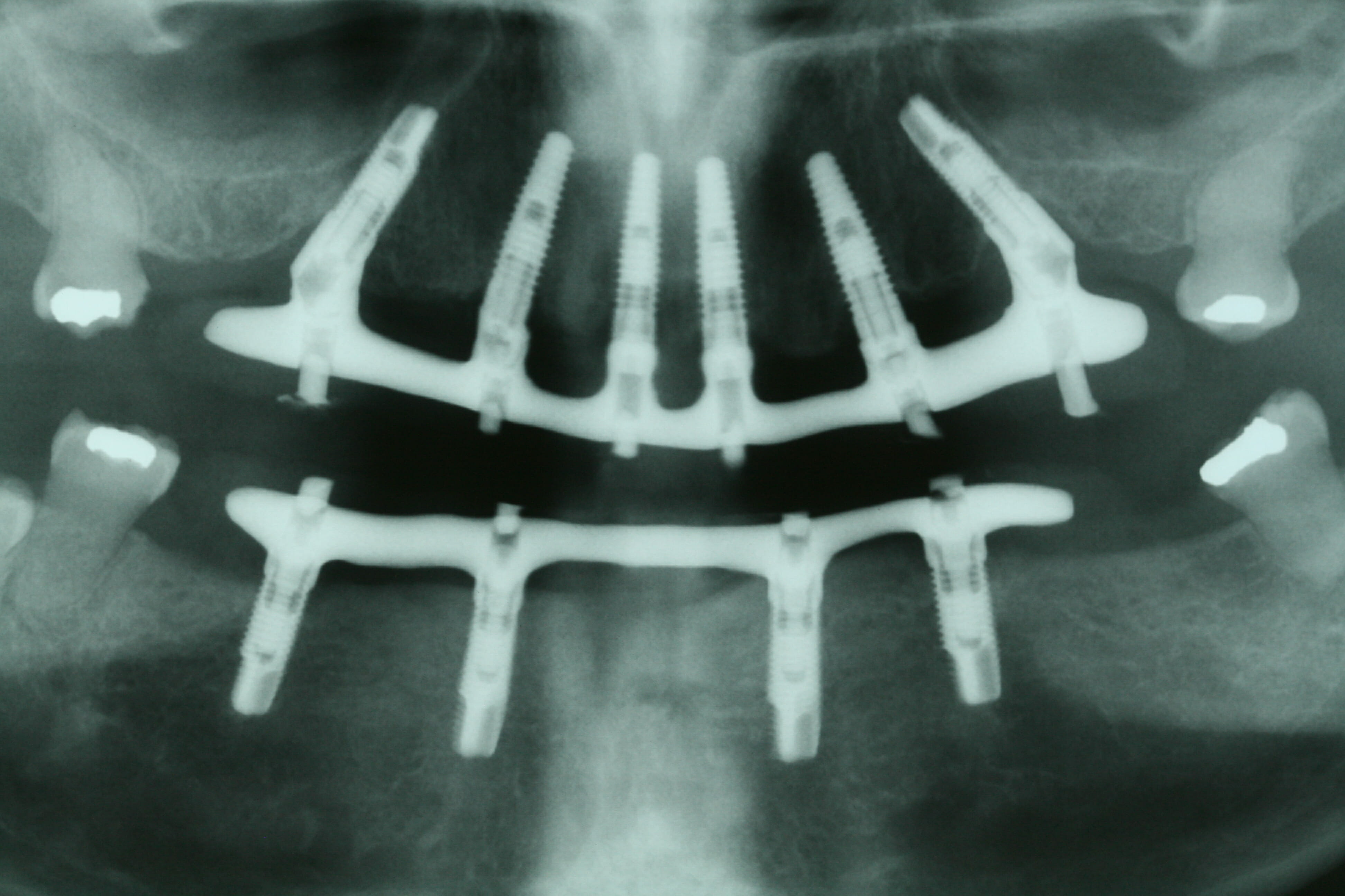 X-Ray