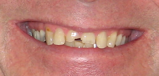 Broken front teeth after a fall!