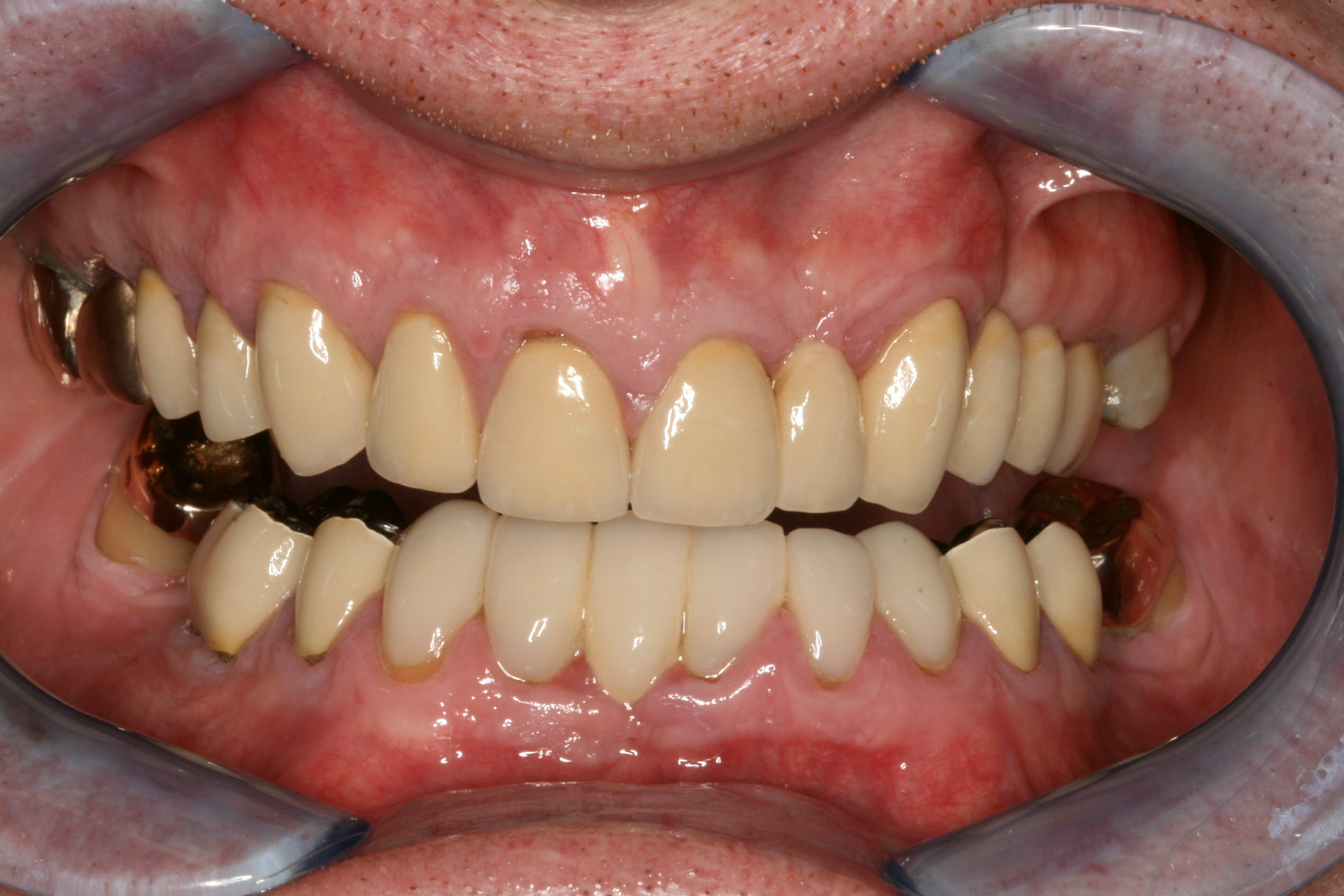 Dental rehabilitation, after