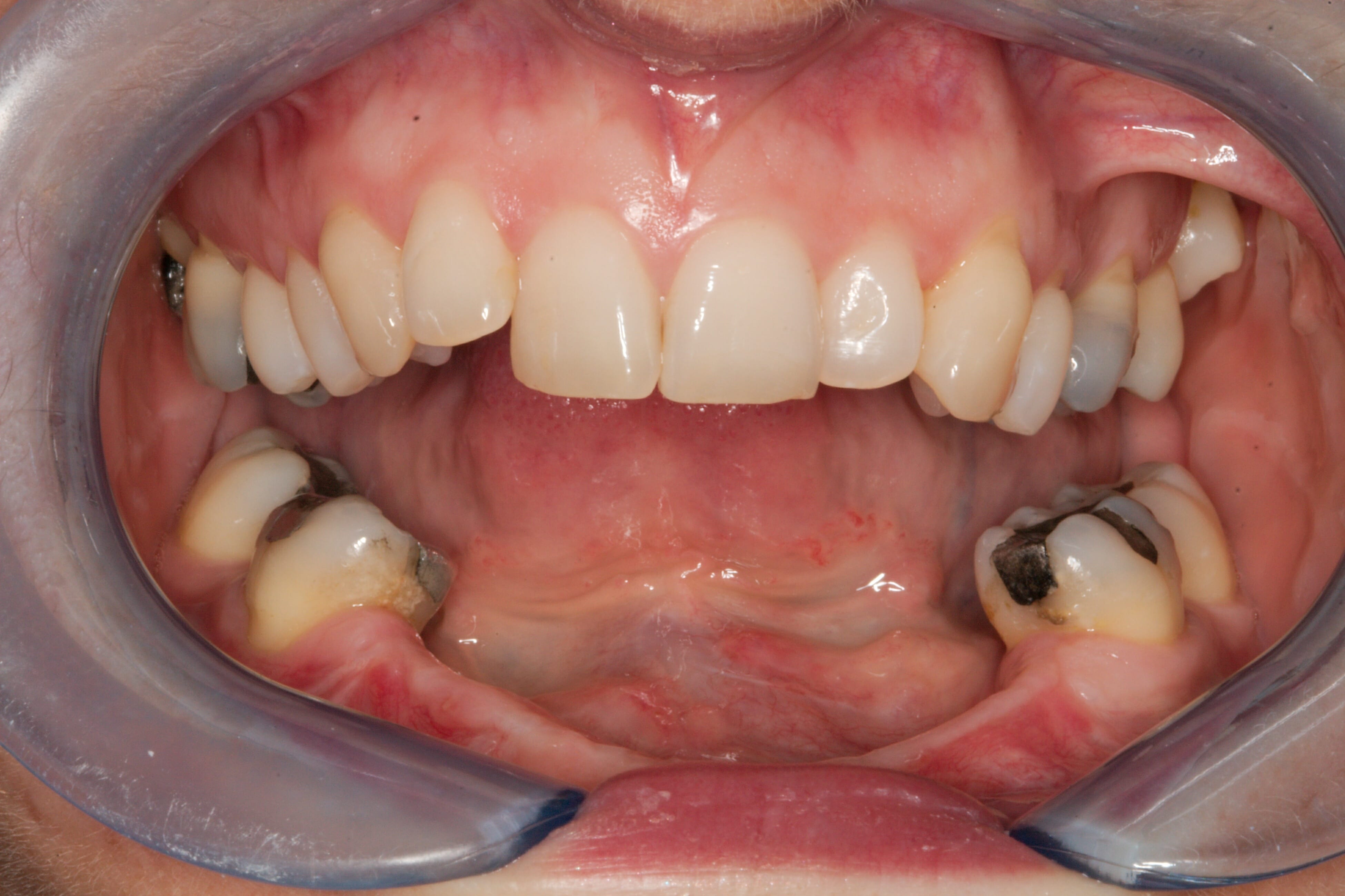 Dental Implants - clinical photograph 7