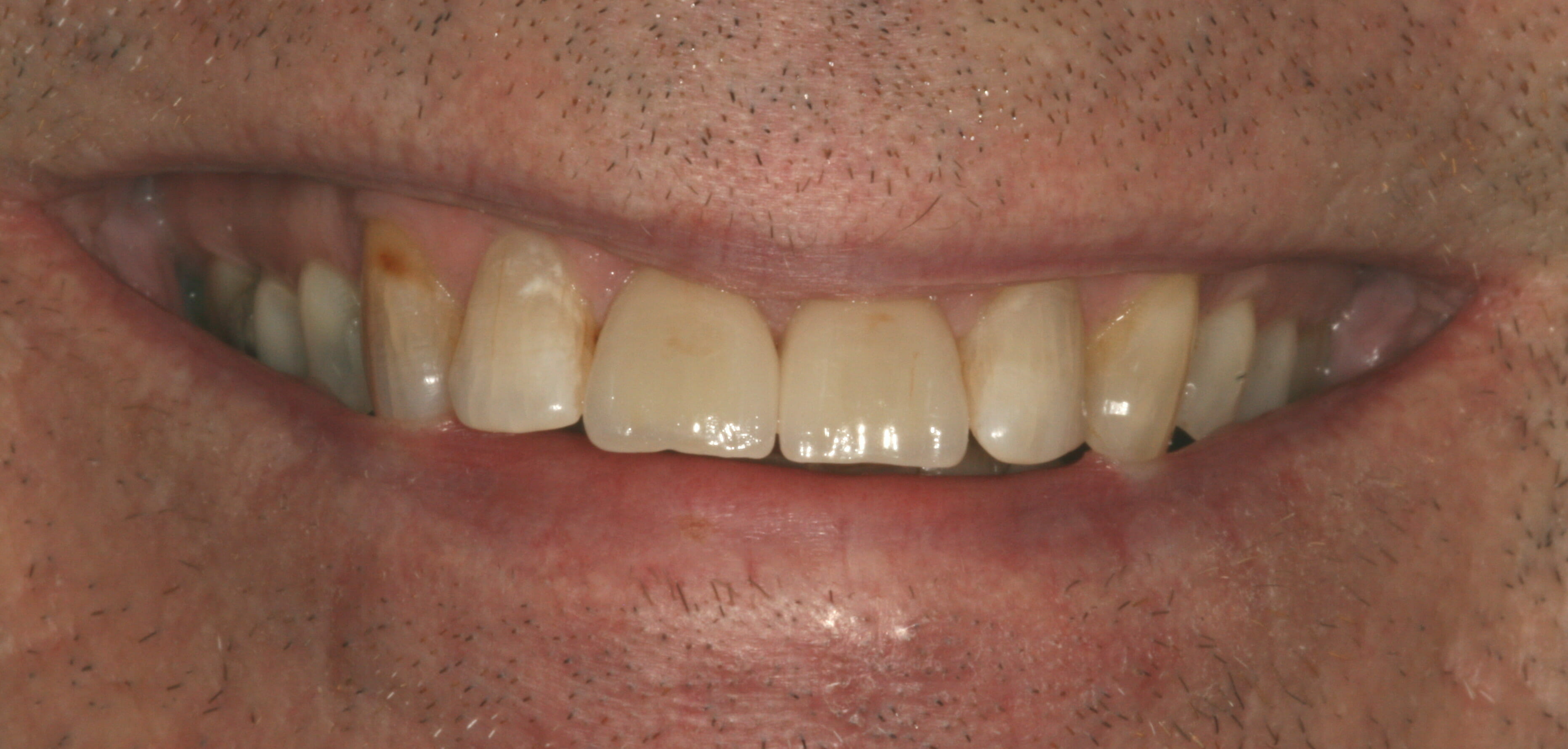 Front teeth repaired with tooth coloured filling material.