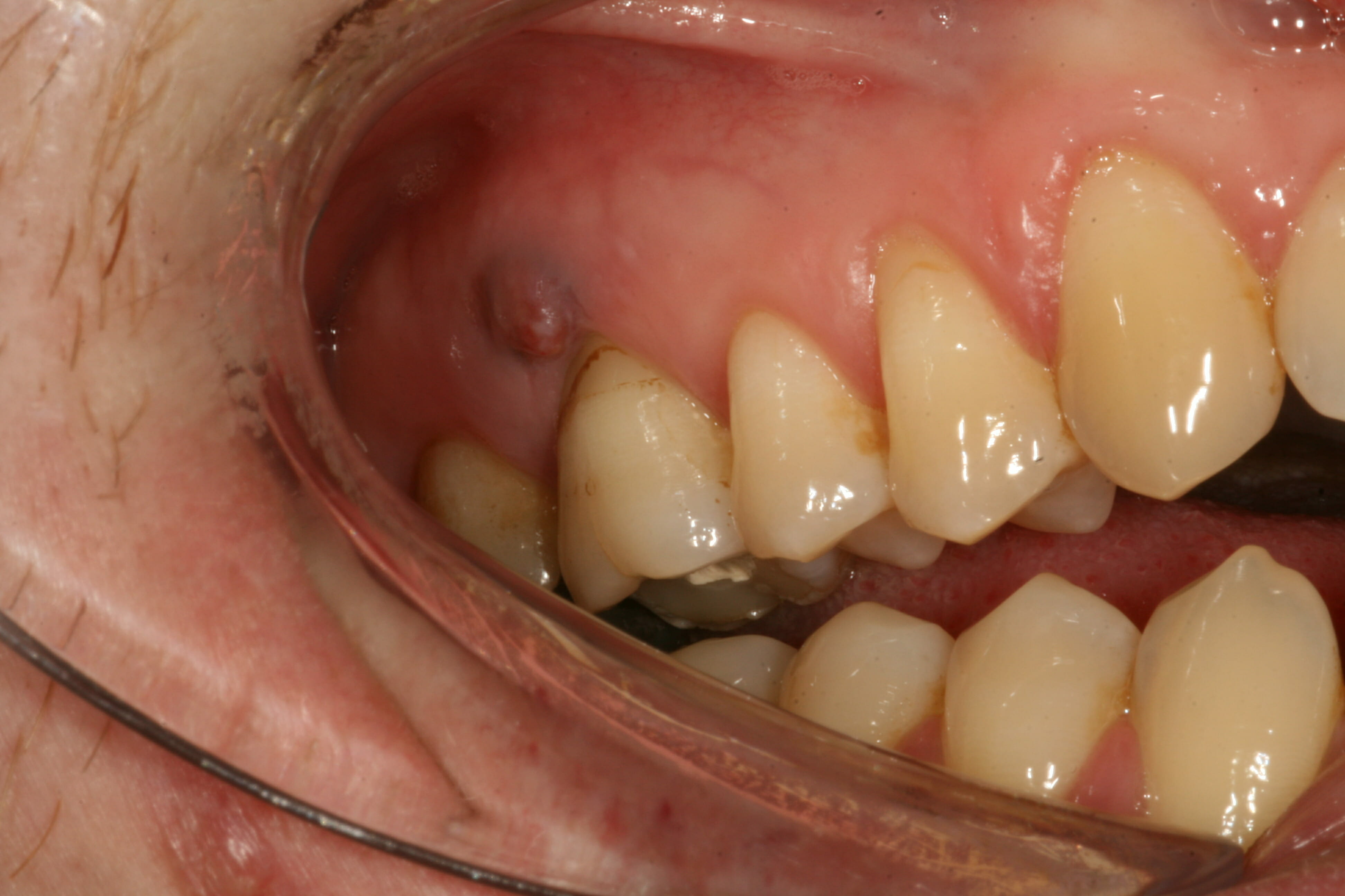 Evidence of infection (a sinus) next to the upper molar.