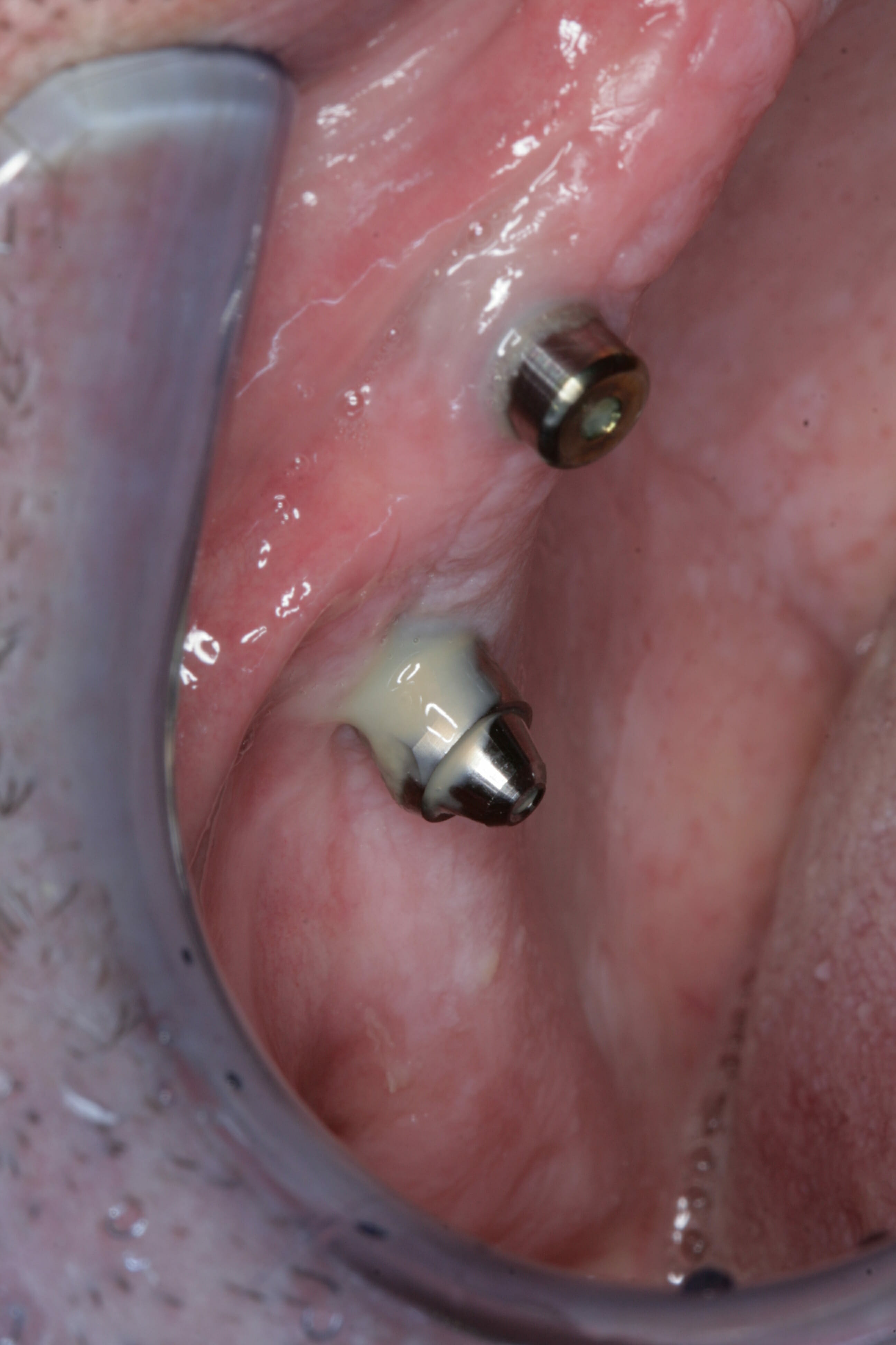 Failing implant with discharging pus
