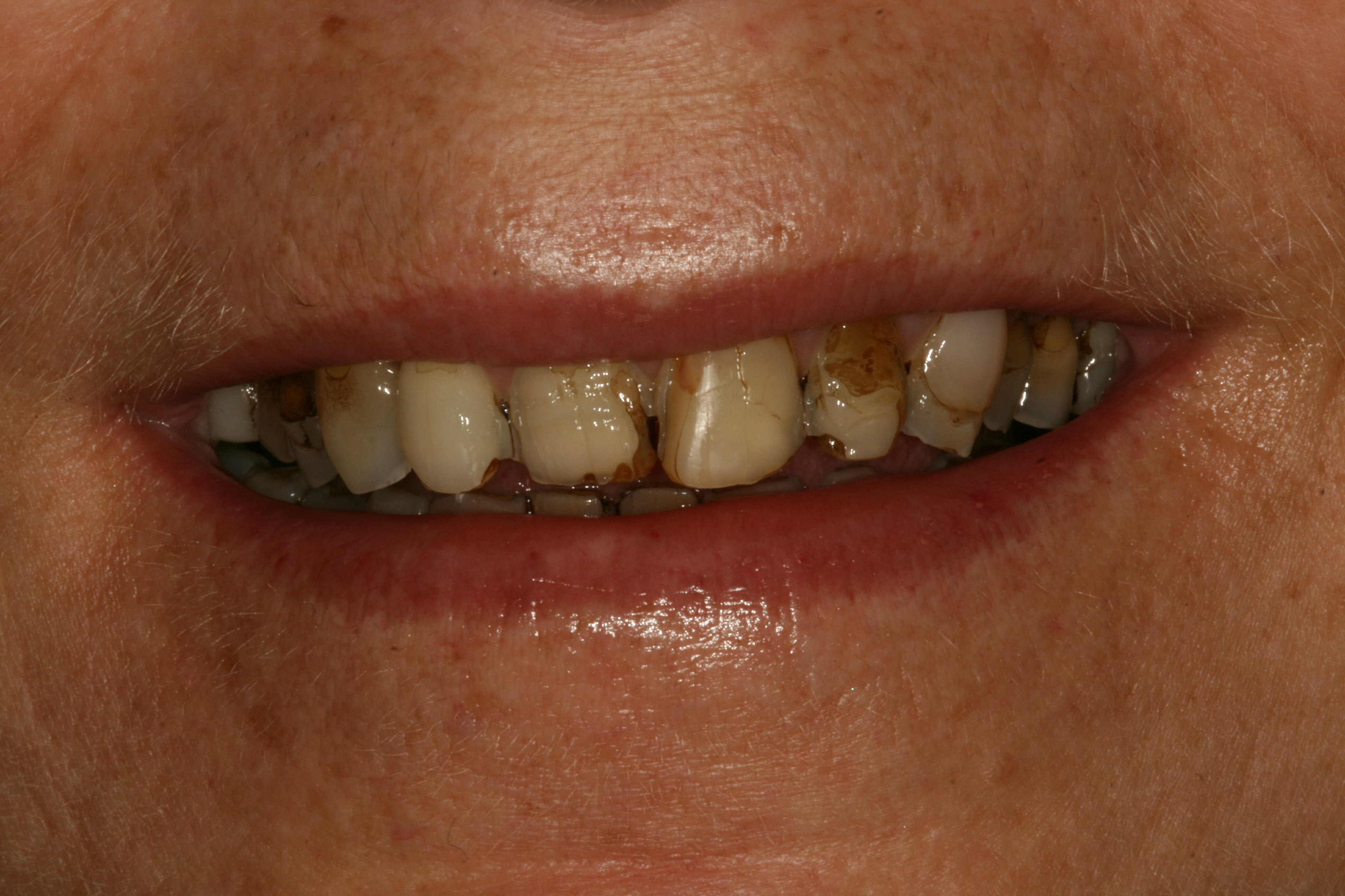 Broken, discoloured fillings - poor cosmetic appearance