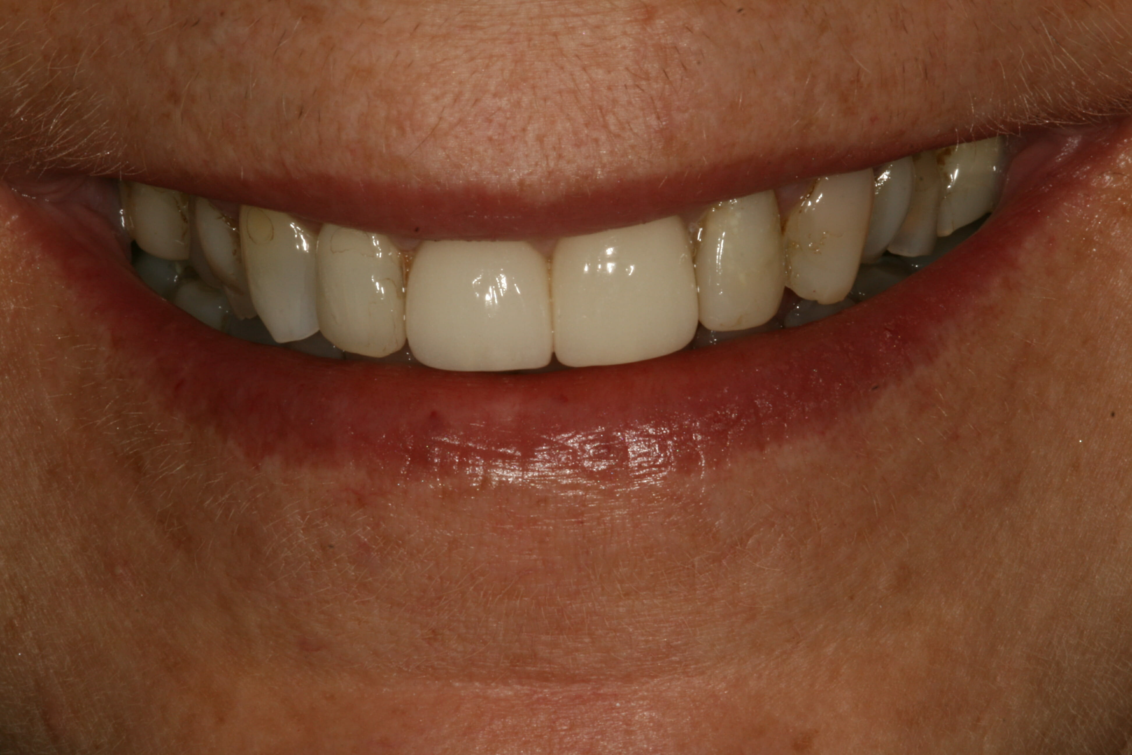 After replacement of fillings and new crowns.
