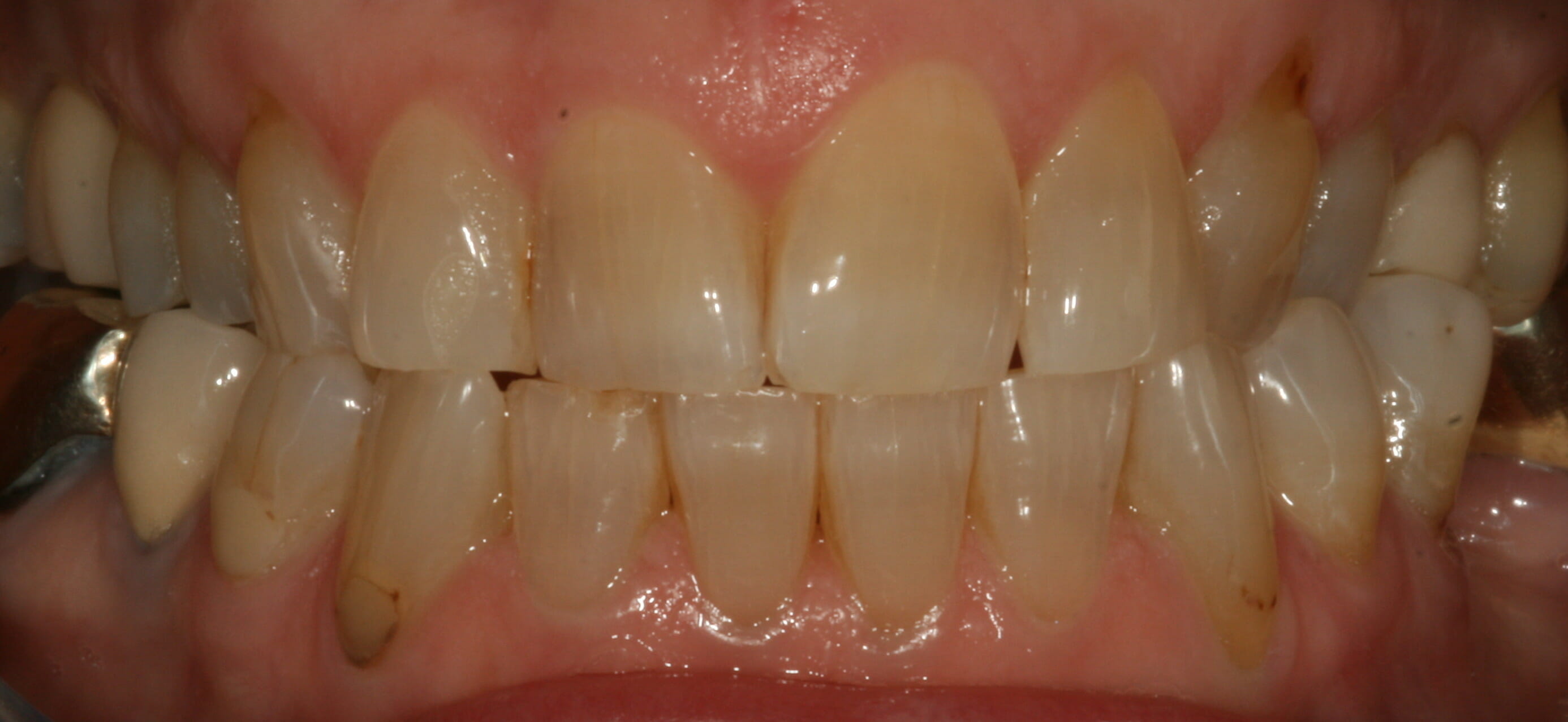 Before Home Whitening