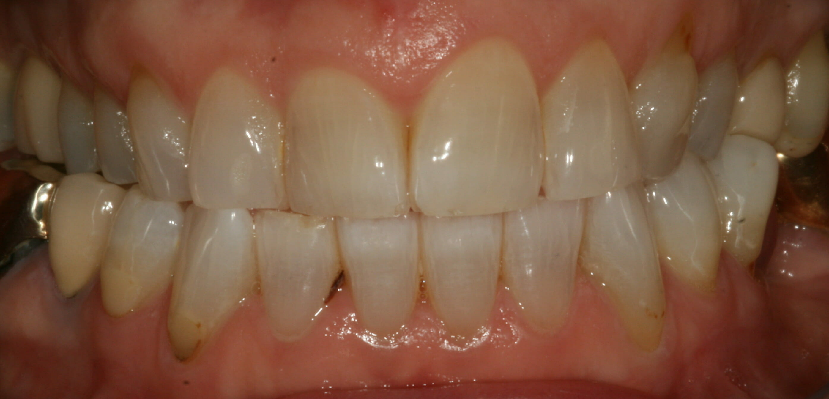 After Home Whitening