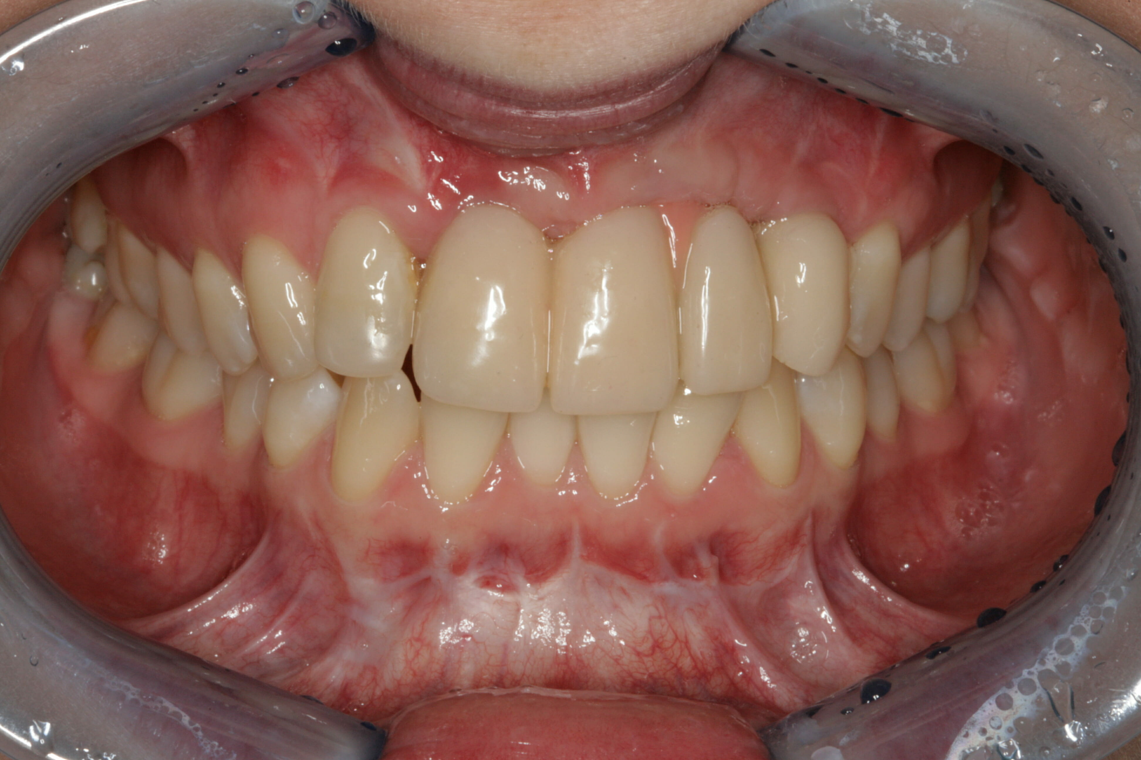 Dental Implants - clinical photograph 6