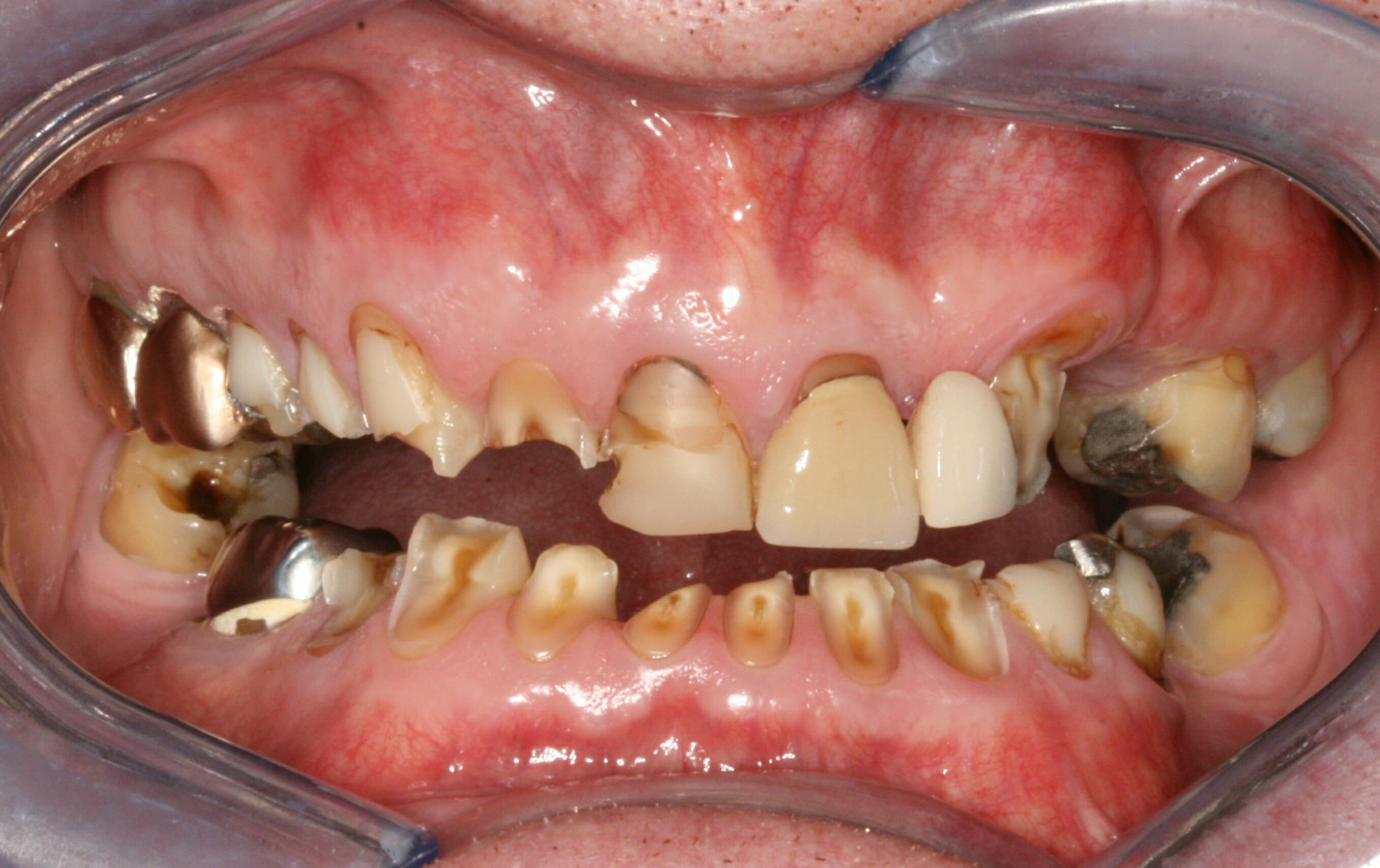 Dental rehabilitation, before