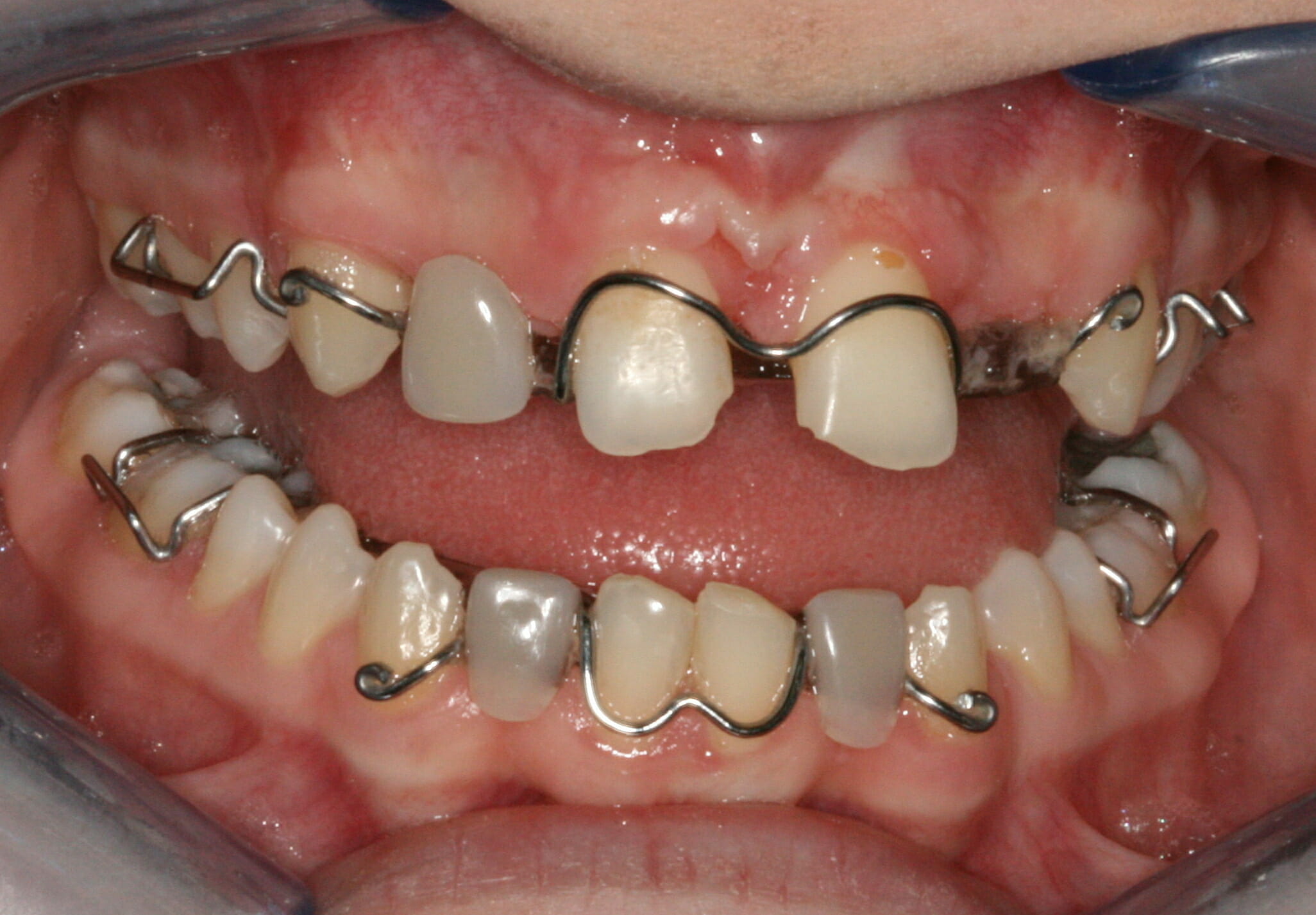 When treatment has gone wrong - clinical photograph 1