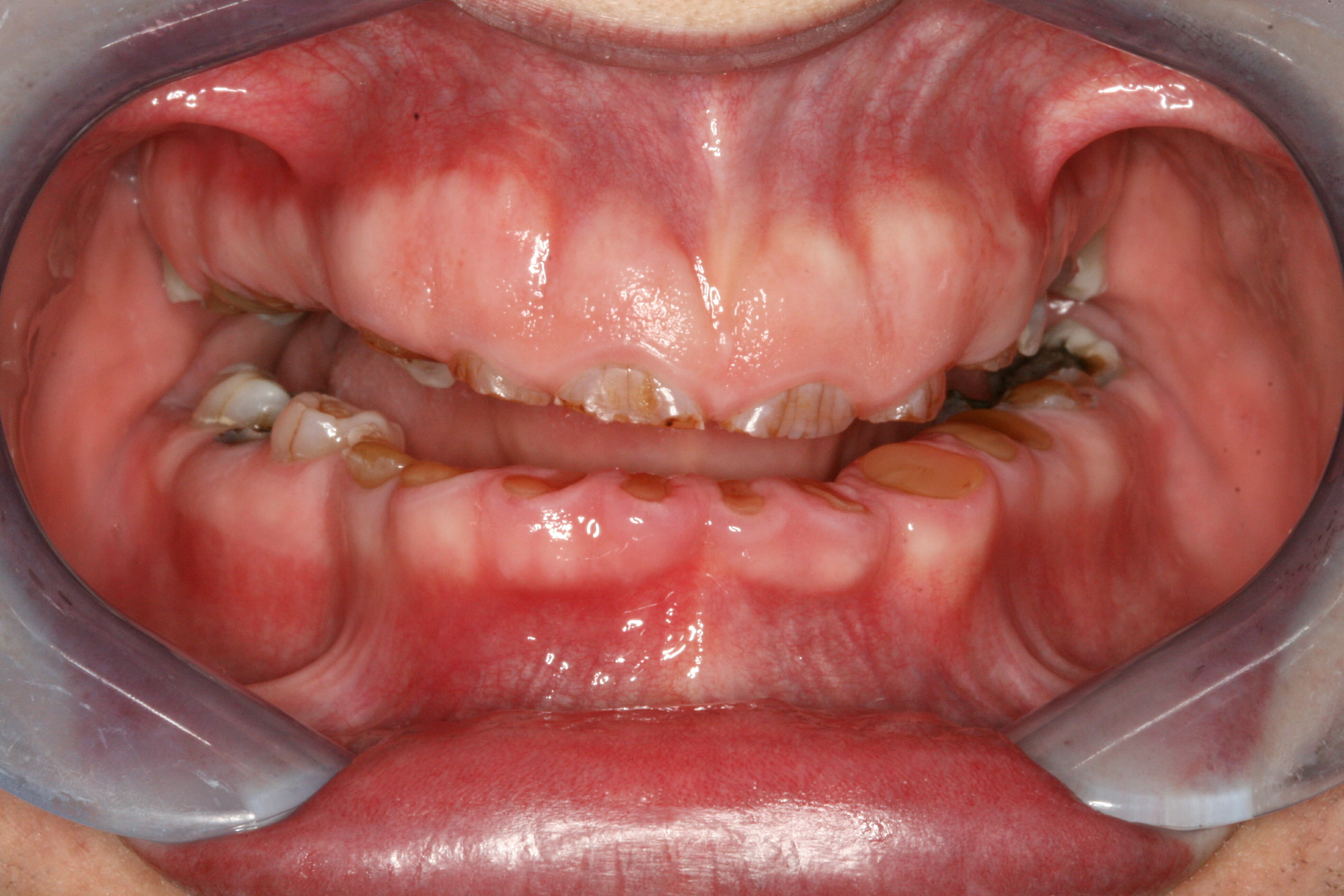 Full Mouth Dental Rehabilitation - clinical photograph 3