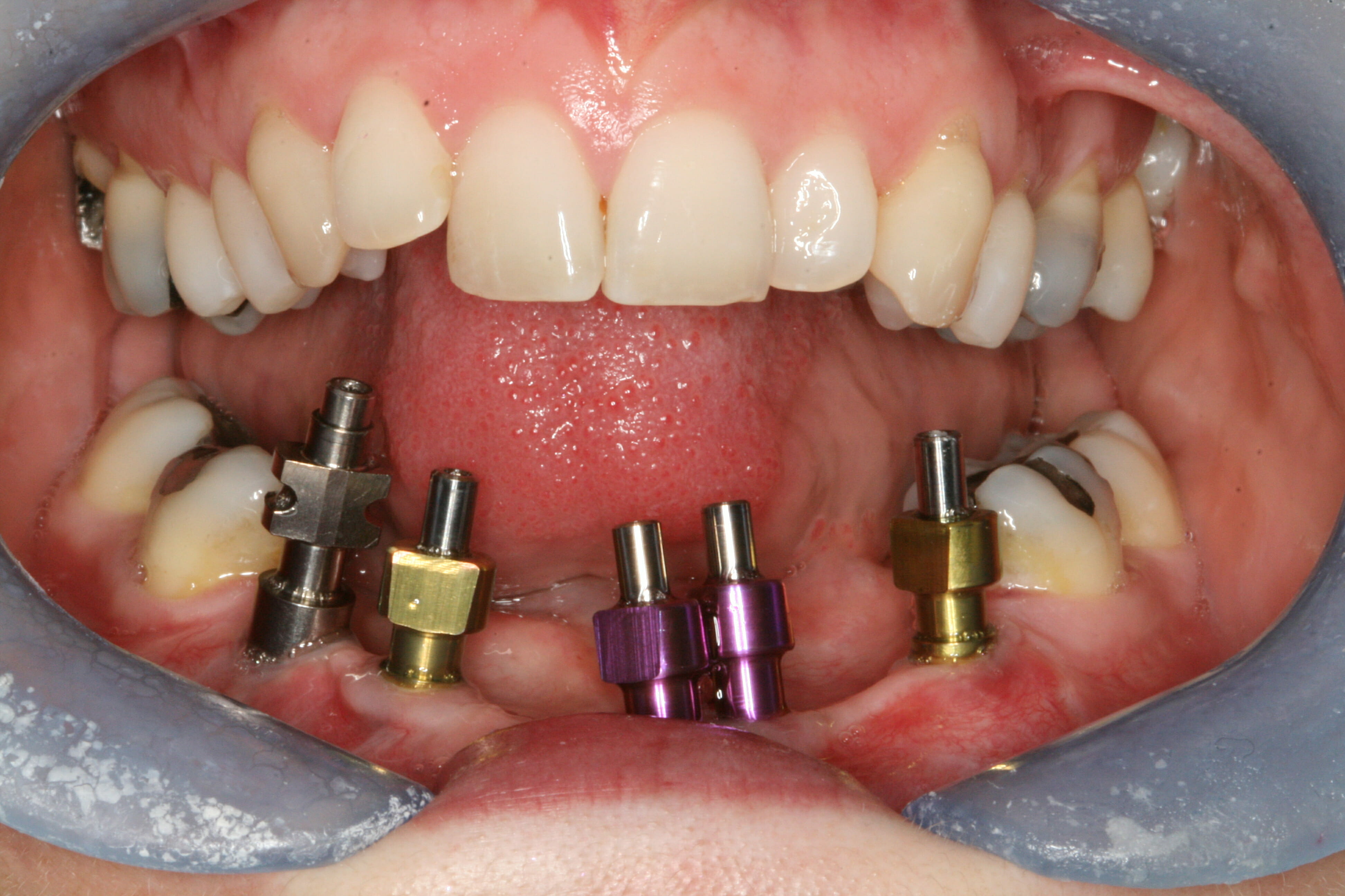 Dental Implants - clinical photograph 8