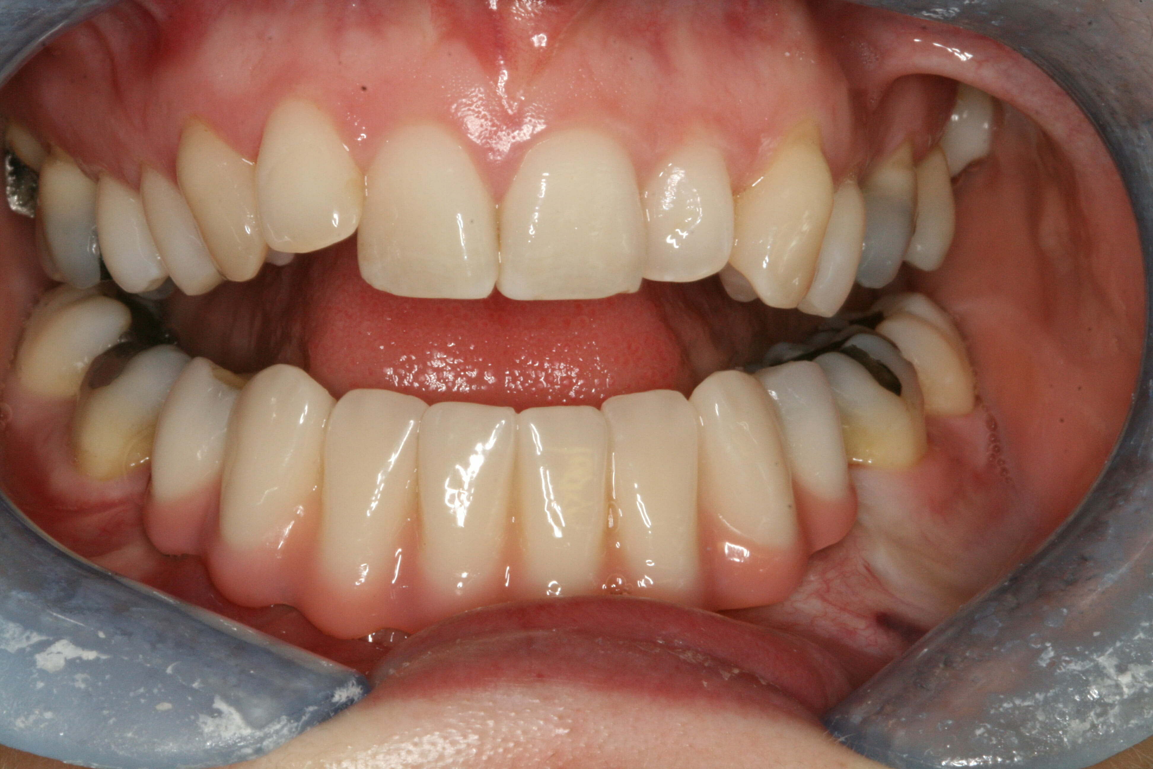 Dental Implants - clinical photograph 9