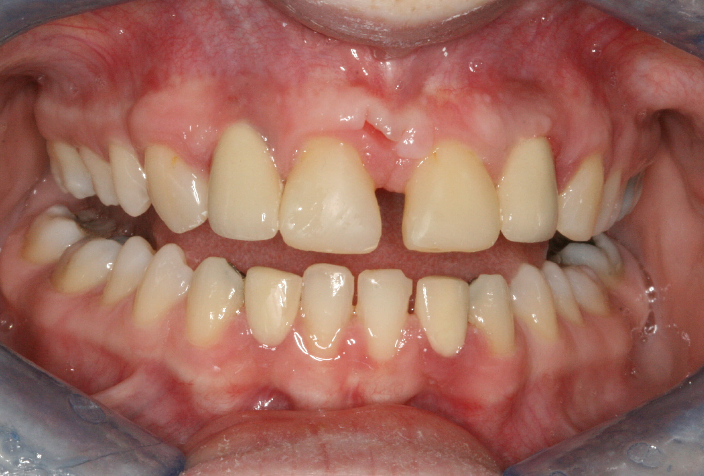 When treatment has gone wrong - clinical photograph 2