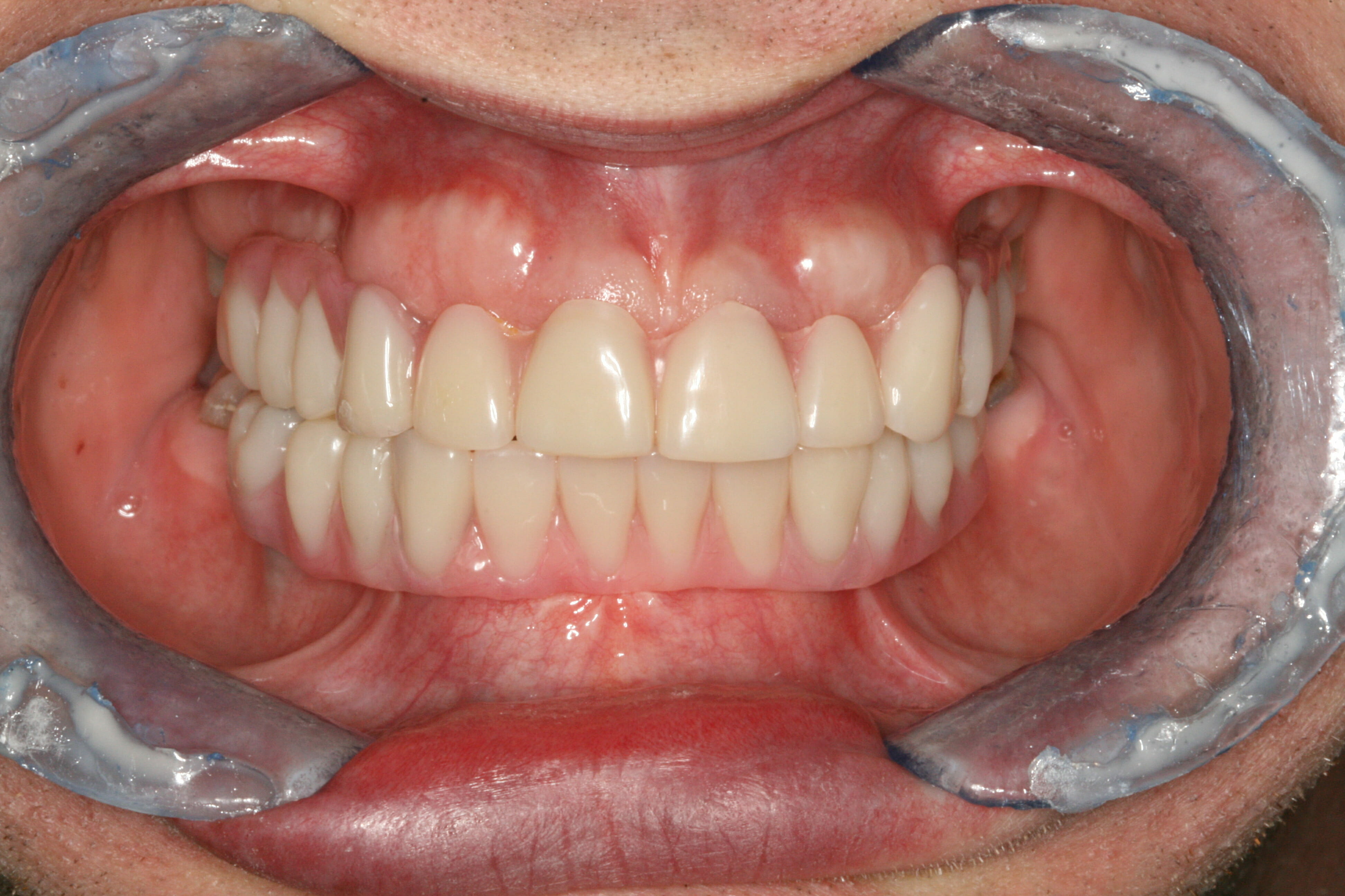 Full Mouth Dental Rehabilitation - clinical photograph 4