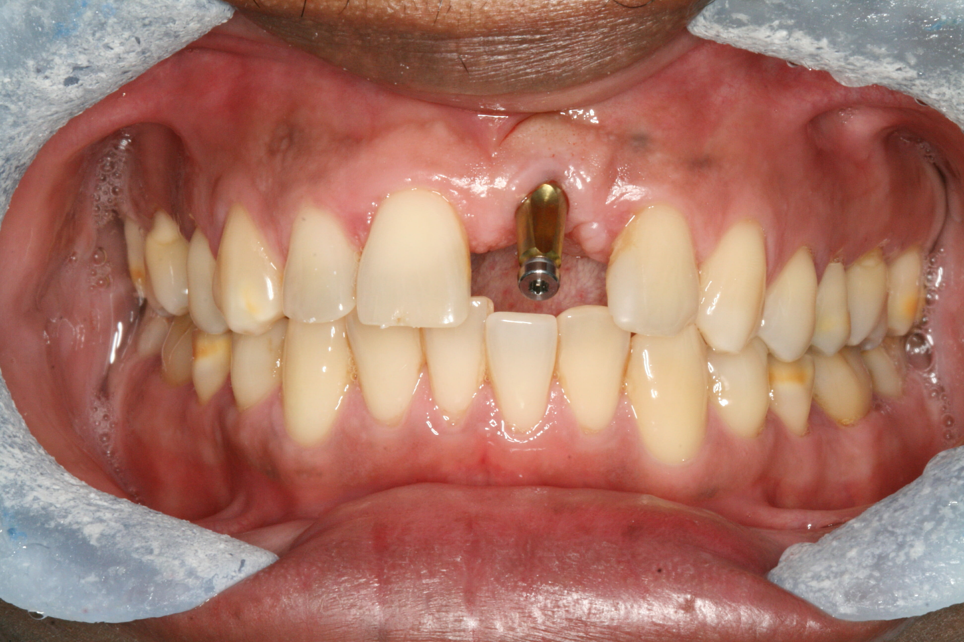 Dental Implants - clinical photograph 1