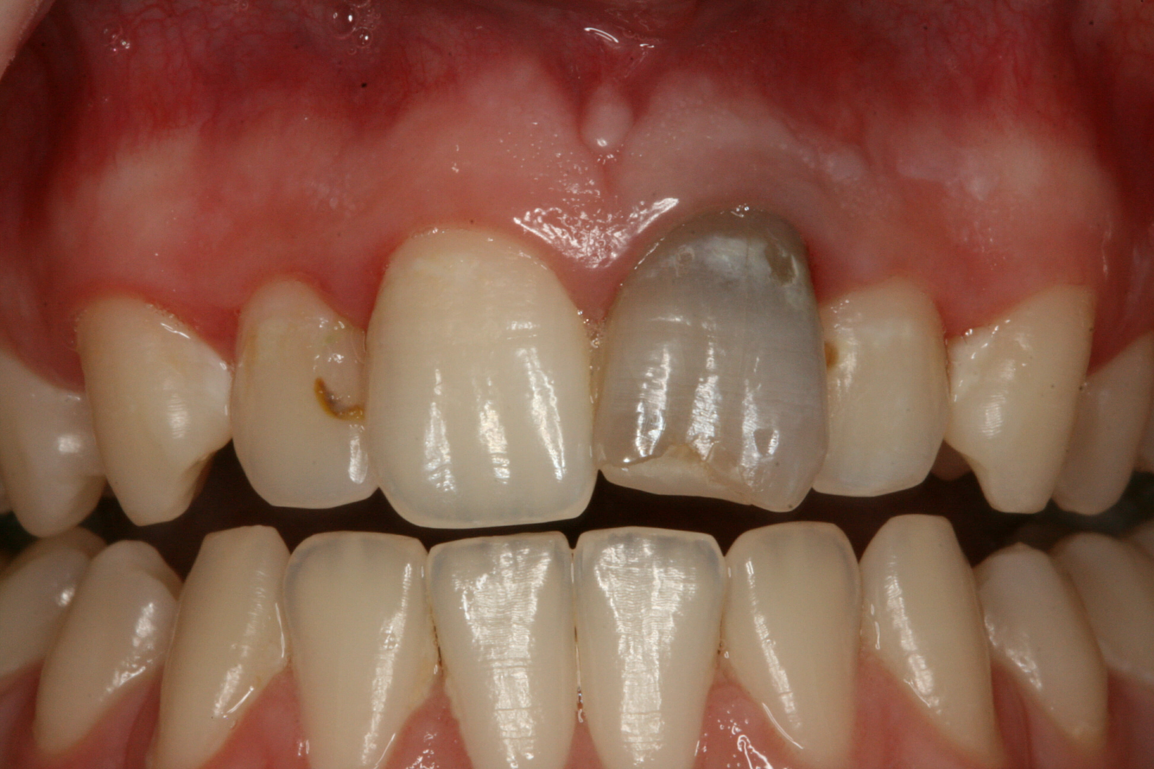 Before single tooth "inside to outside" bleaching
