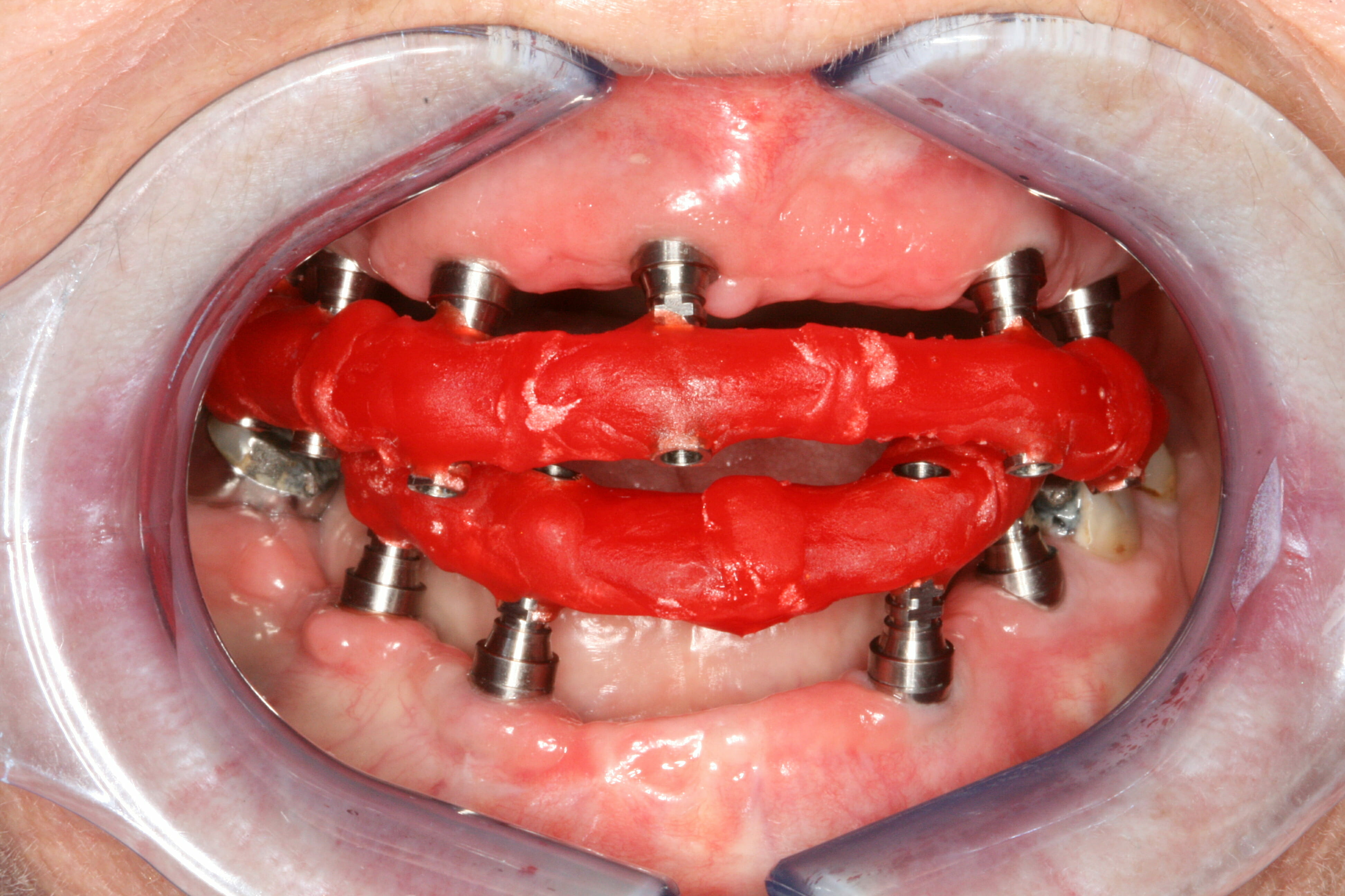 Dental Implants - clinical photograph 3
