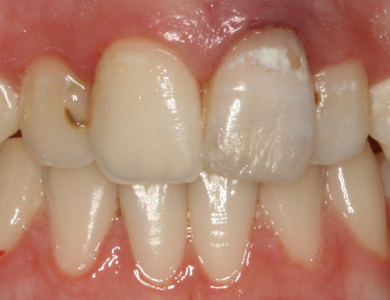 After single tooth "inside to outside" bleaching