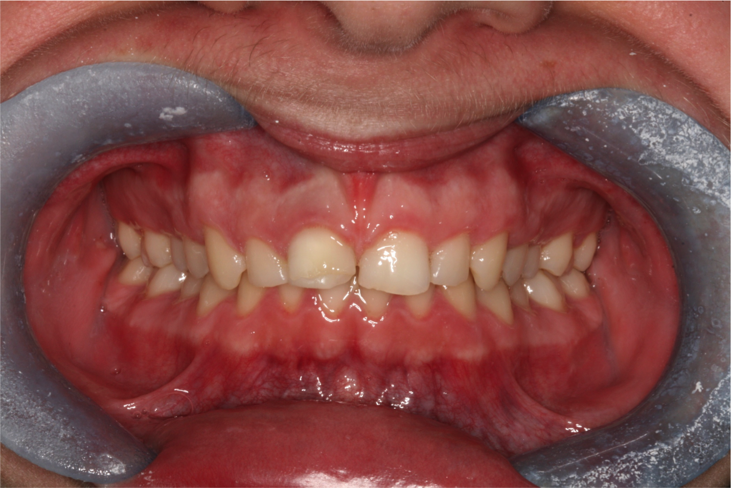 After single tooth "inside to outside" bleaching