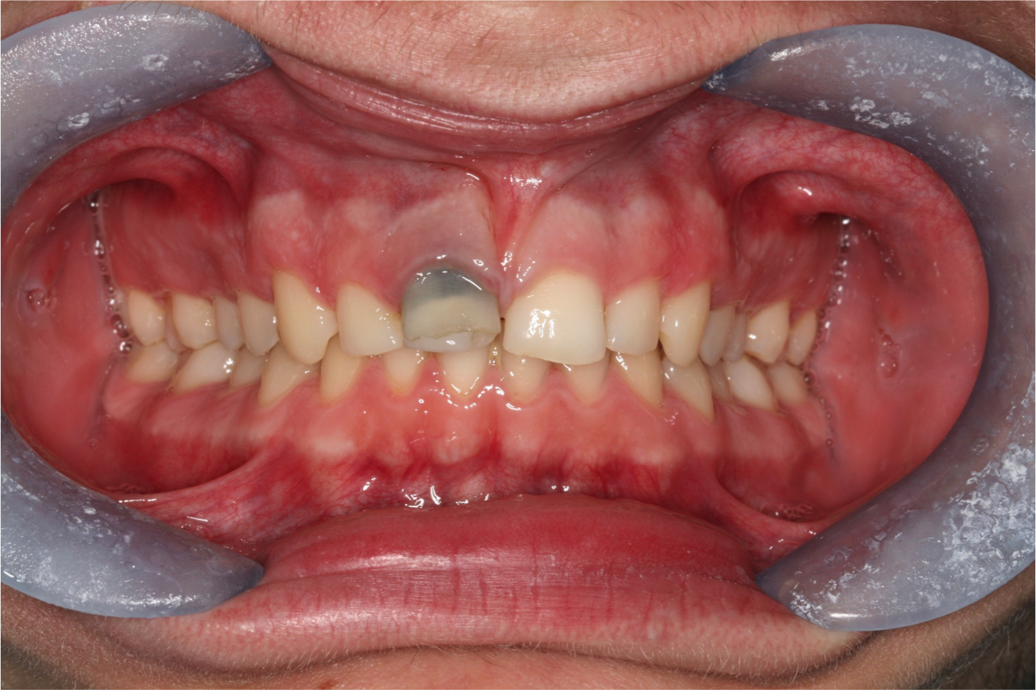 Before single tooth "inside to outside" bleaching