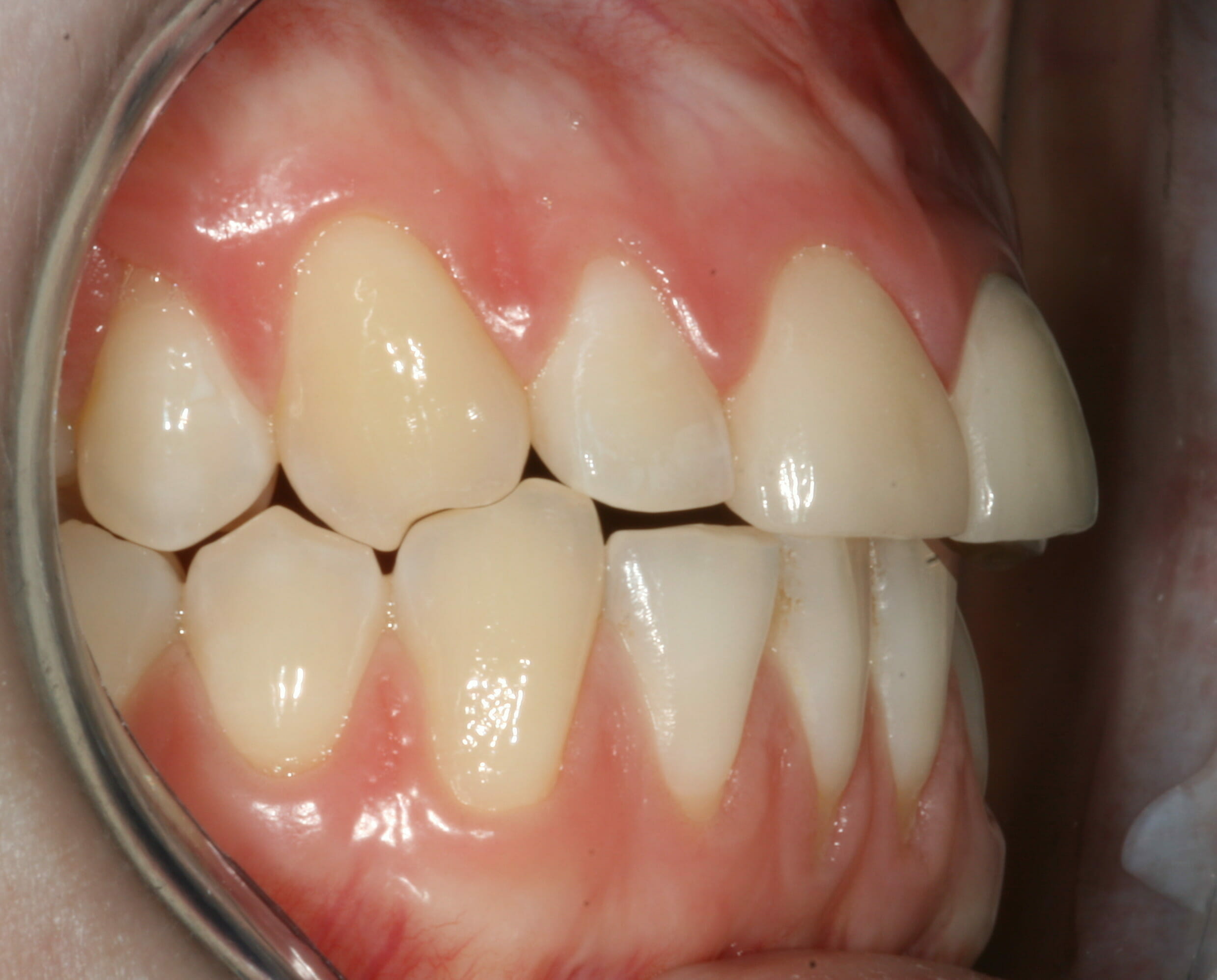 Temporomandibular Joint Disorder - clinical photograph 1