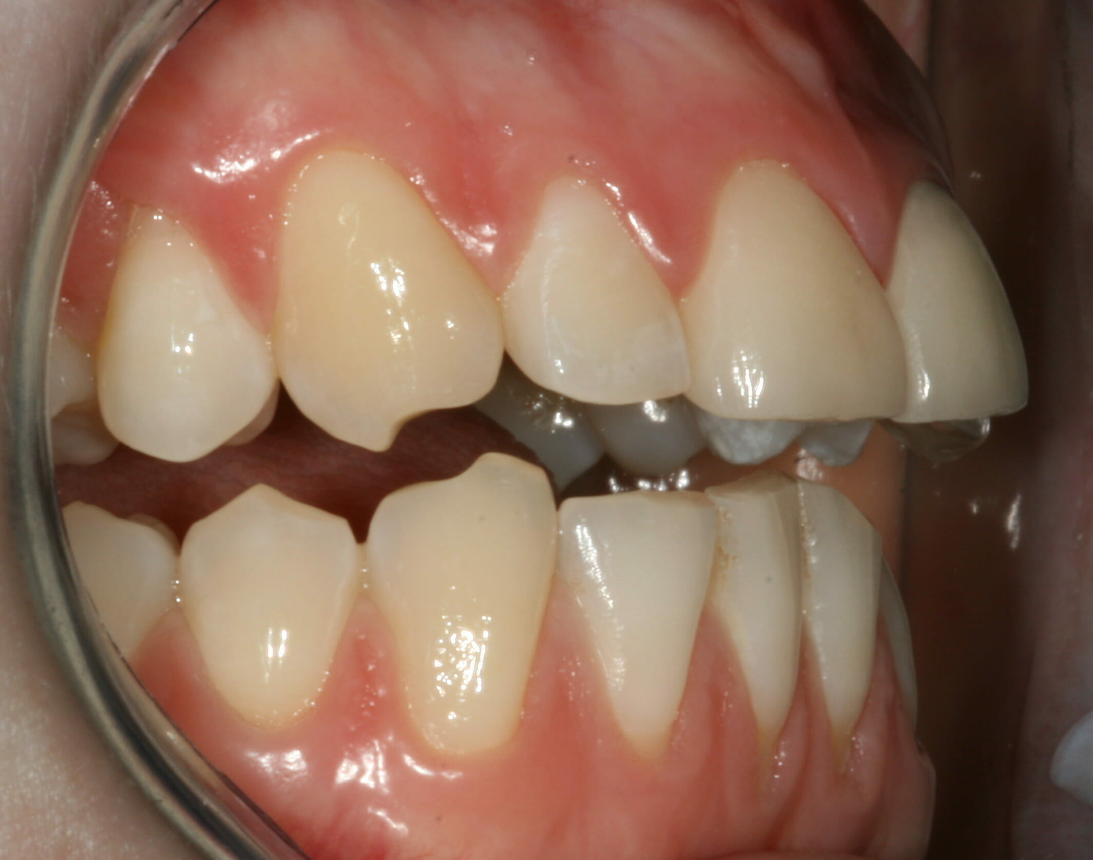 Temporomandibular Joint Disorder - clinical photograph 2